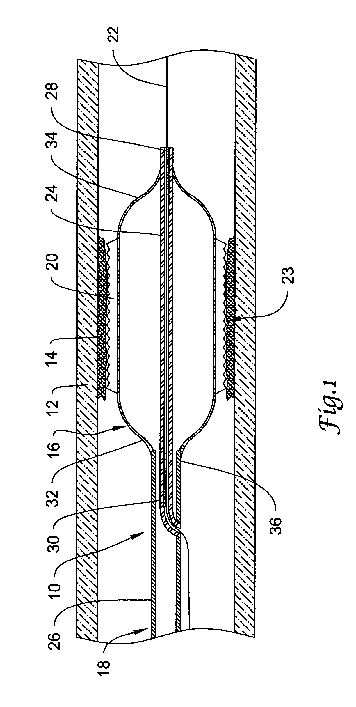 Traction cutting balloon