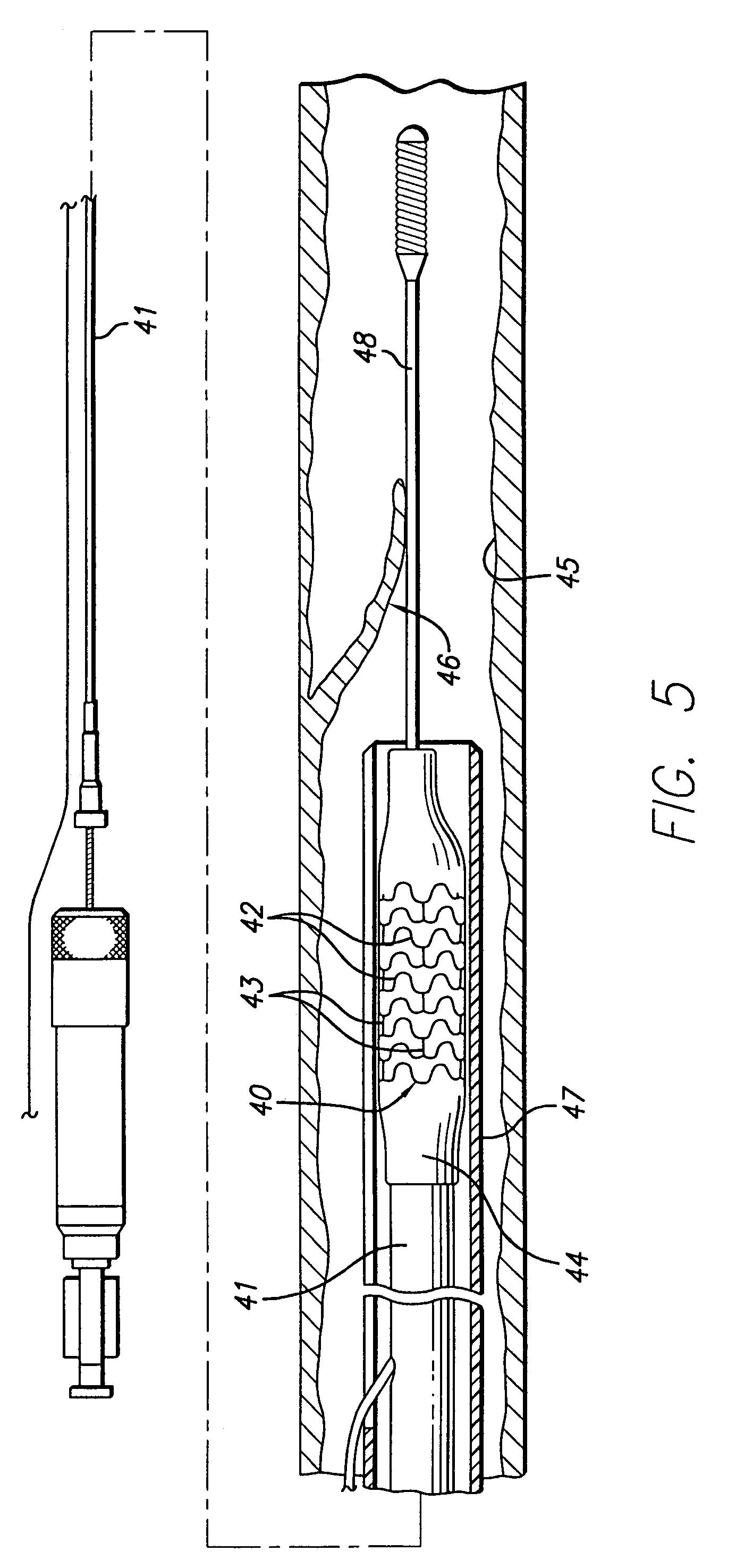 Multilayer stent