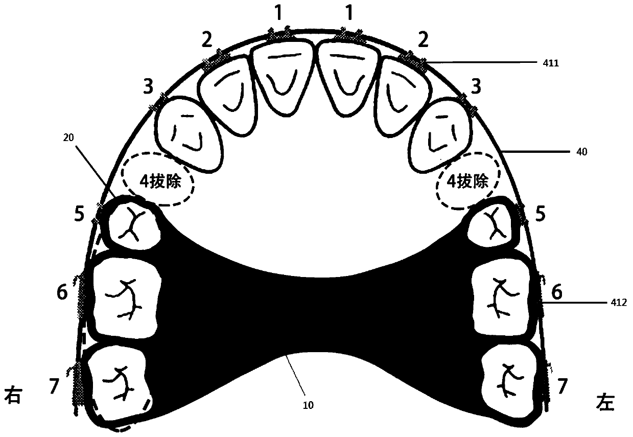 Auxiliary orthodontic tooth moving matching device for minimally invasive jaw surgery