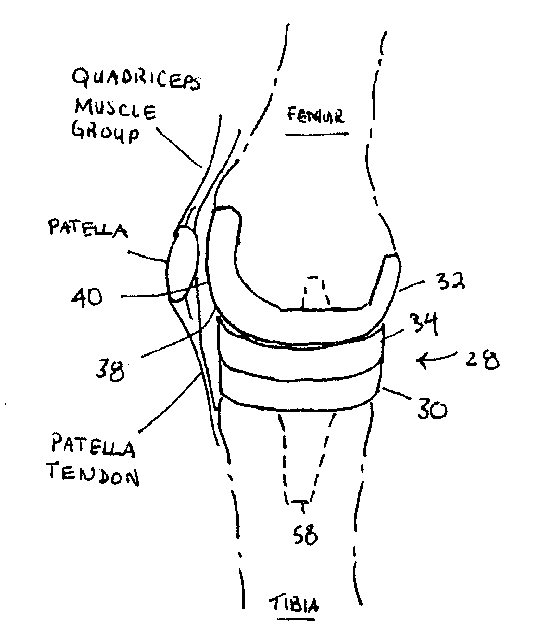 Knee prosthesis