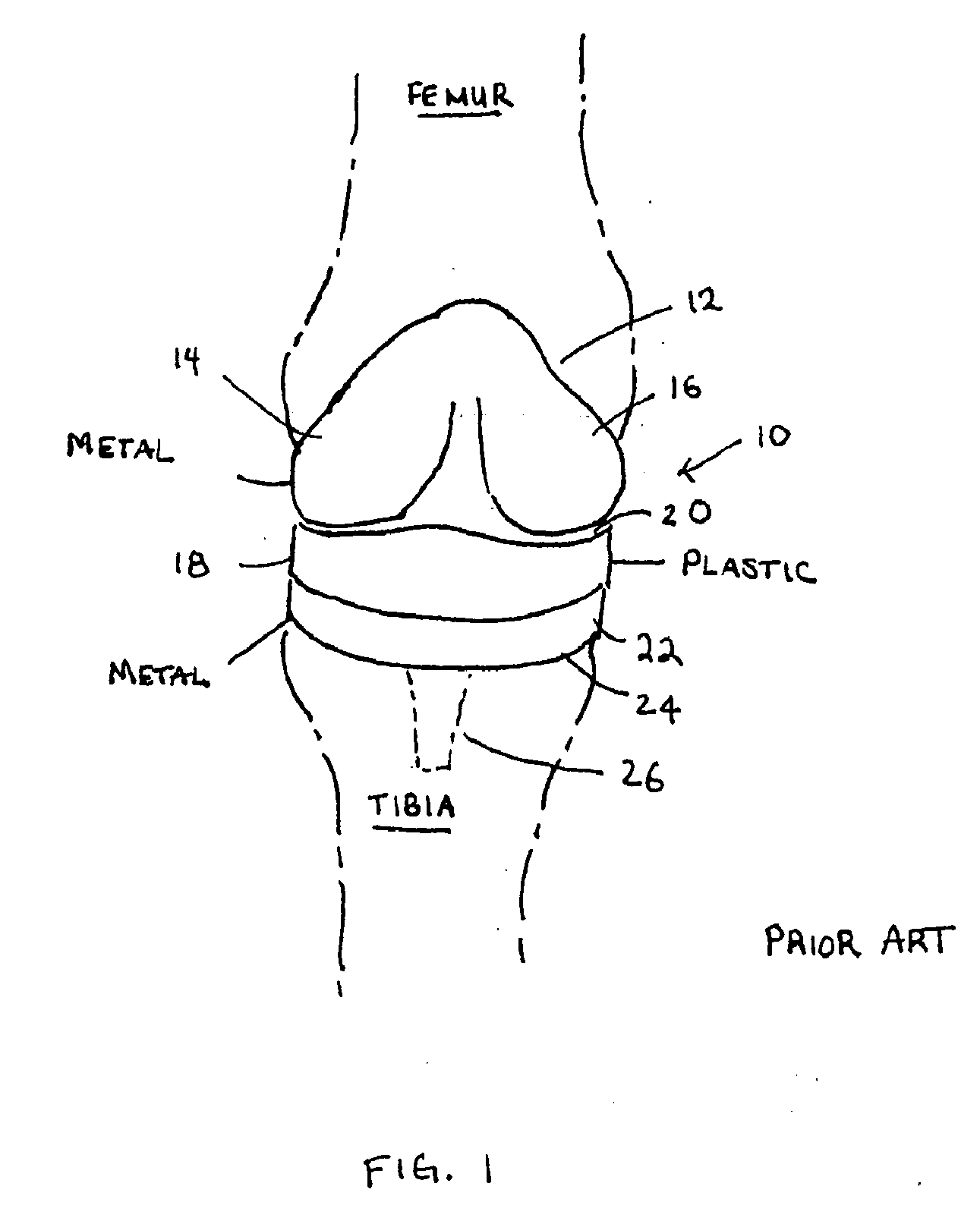 Knee prosthesis