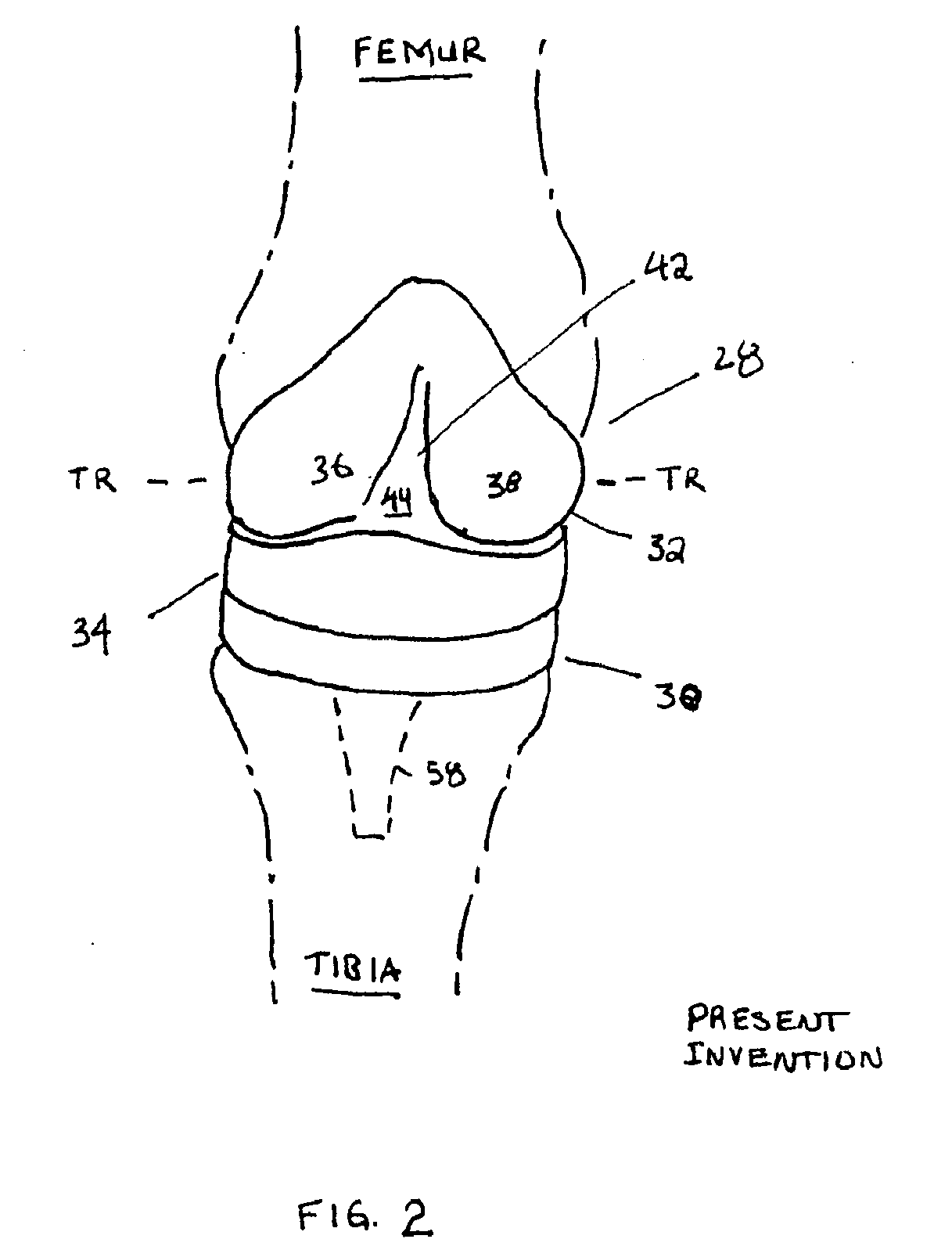 Knee prosthesis