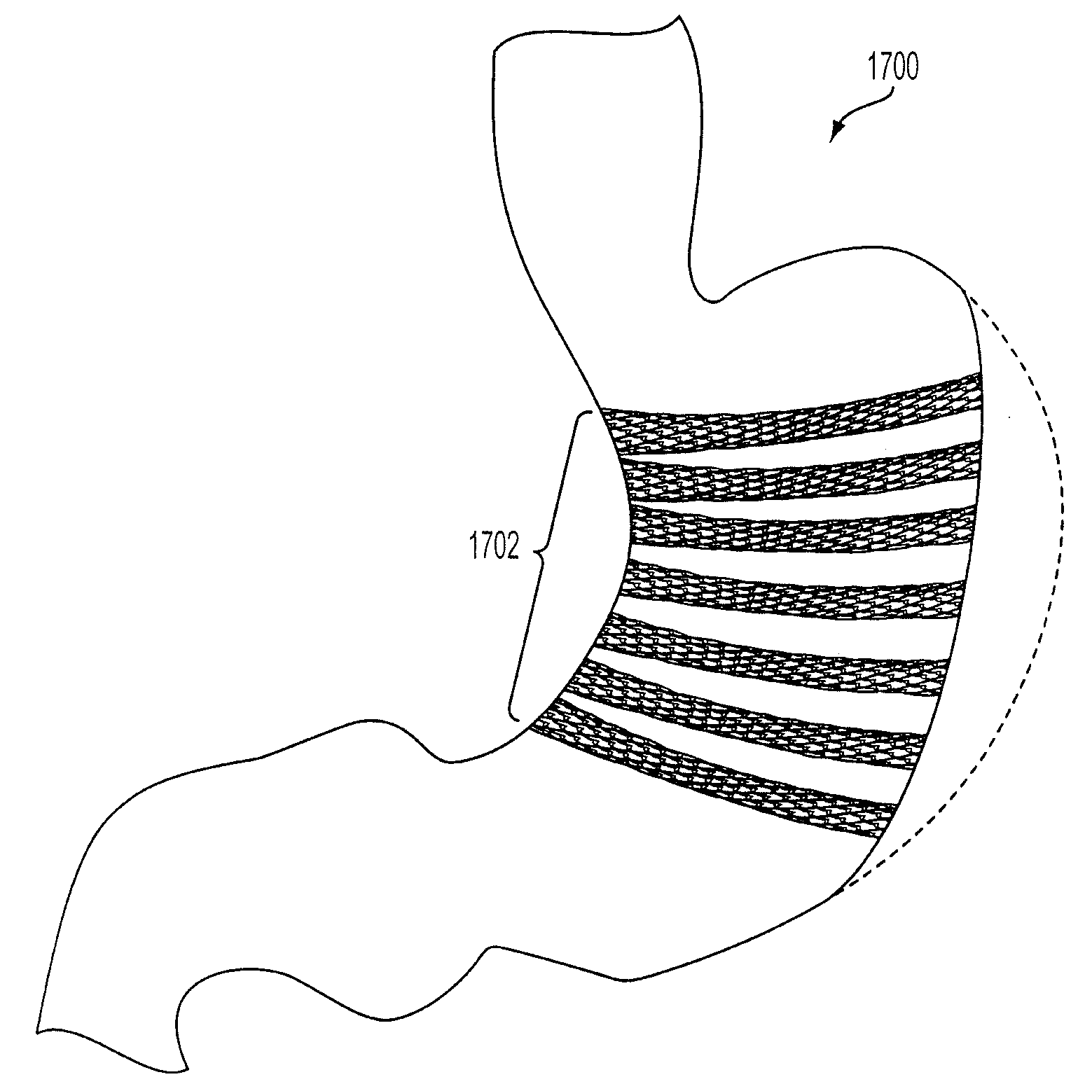 Method and apparatus for gastric restriction of the stomach to treat obesity