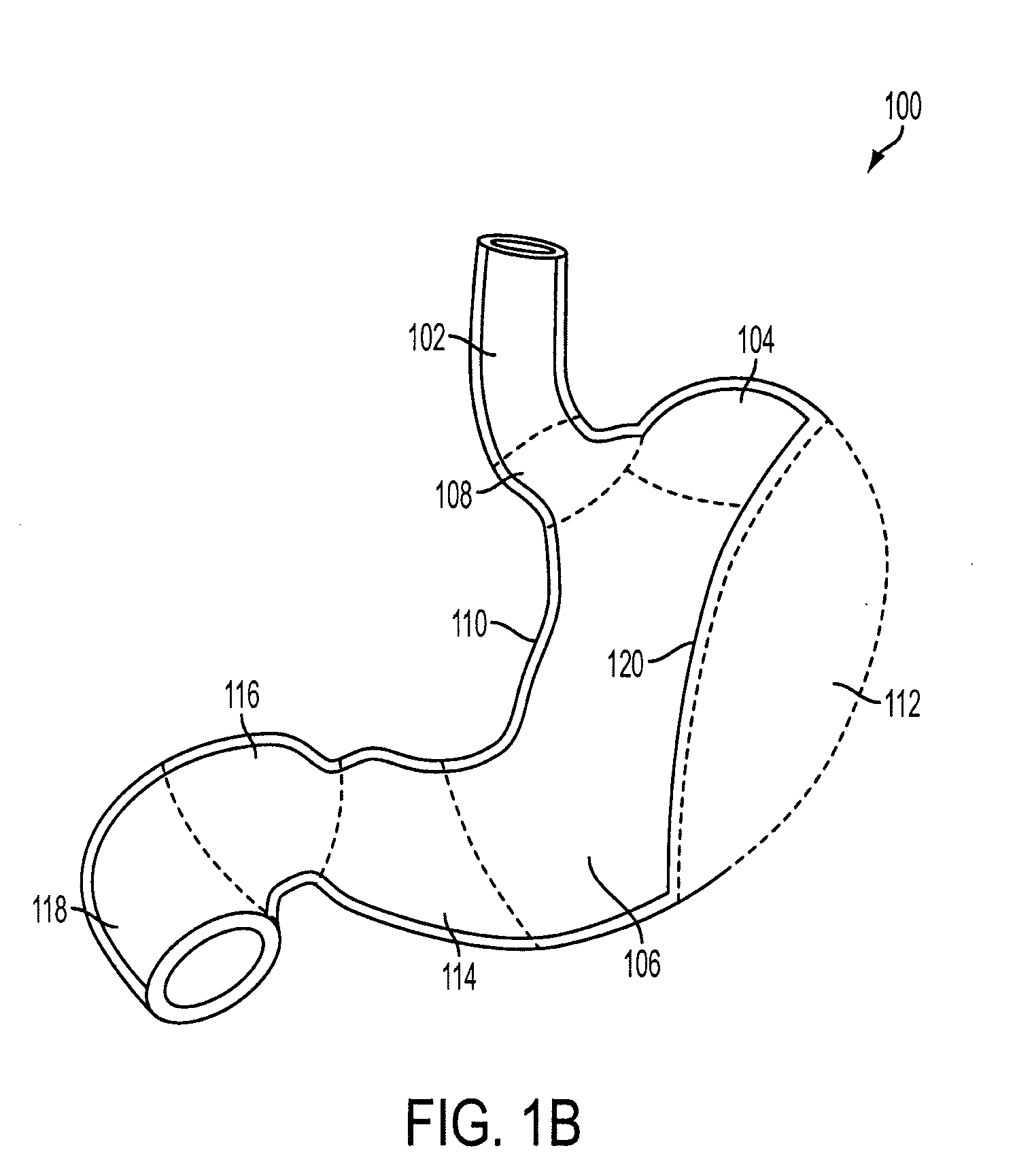 Method and apparatus for gastric restriction of the stomach to treat obesity