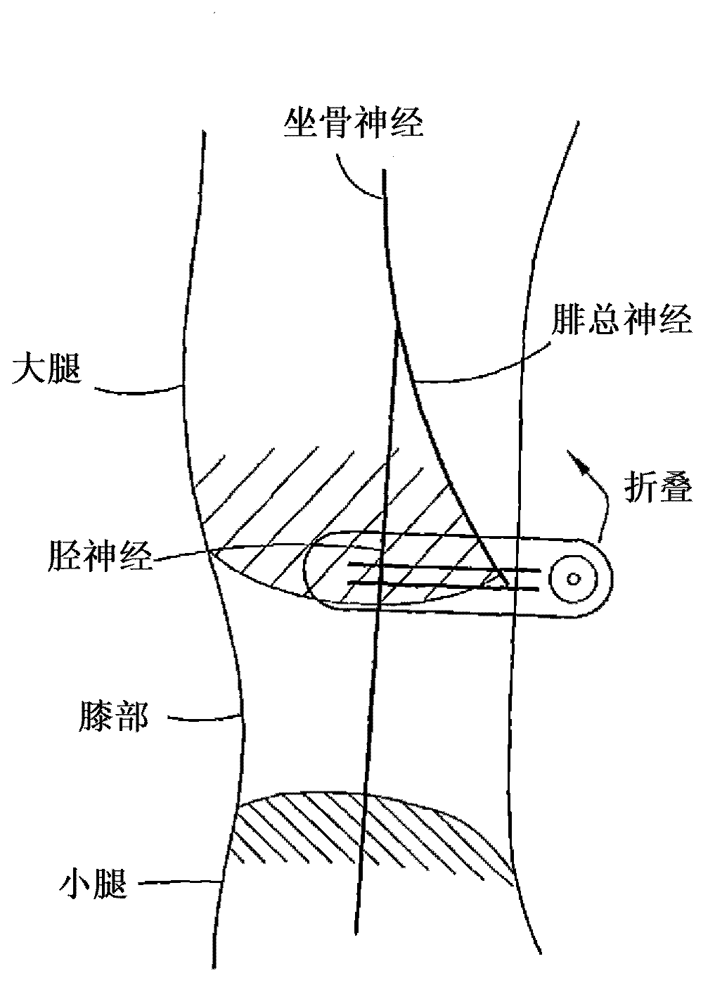 Incontinence treatment