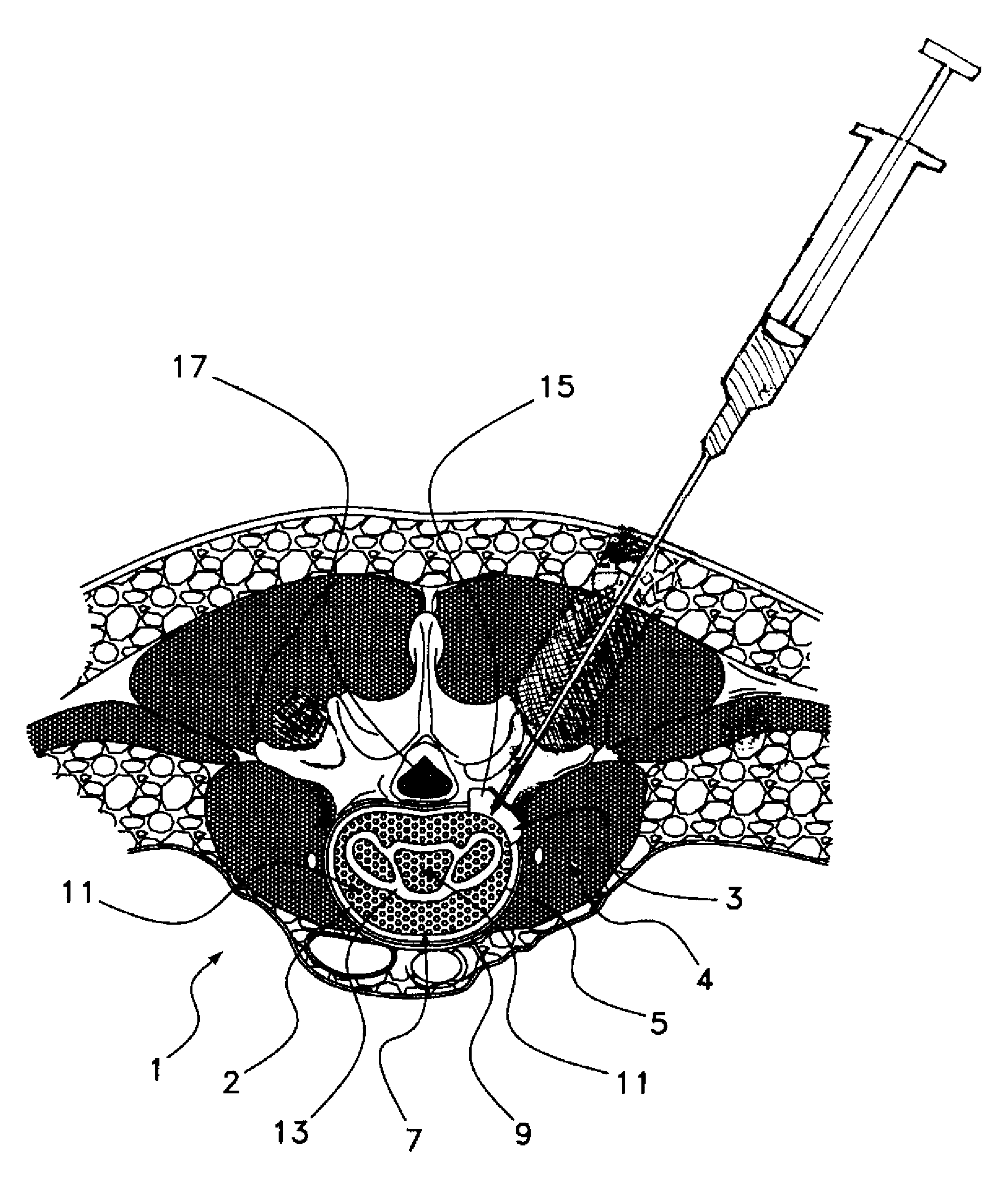 Method of using an anti-growth matrix as a barrier for cell attachment and osteo-inductive factors