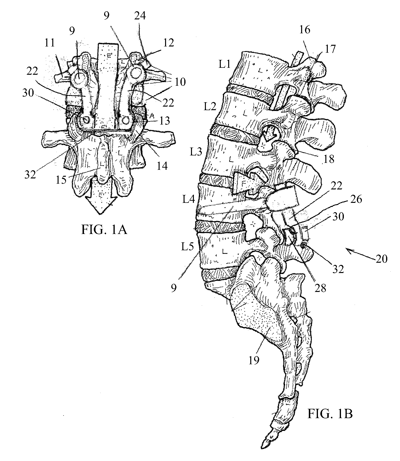 Posterior-medial facet support assembly