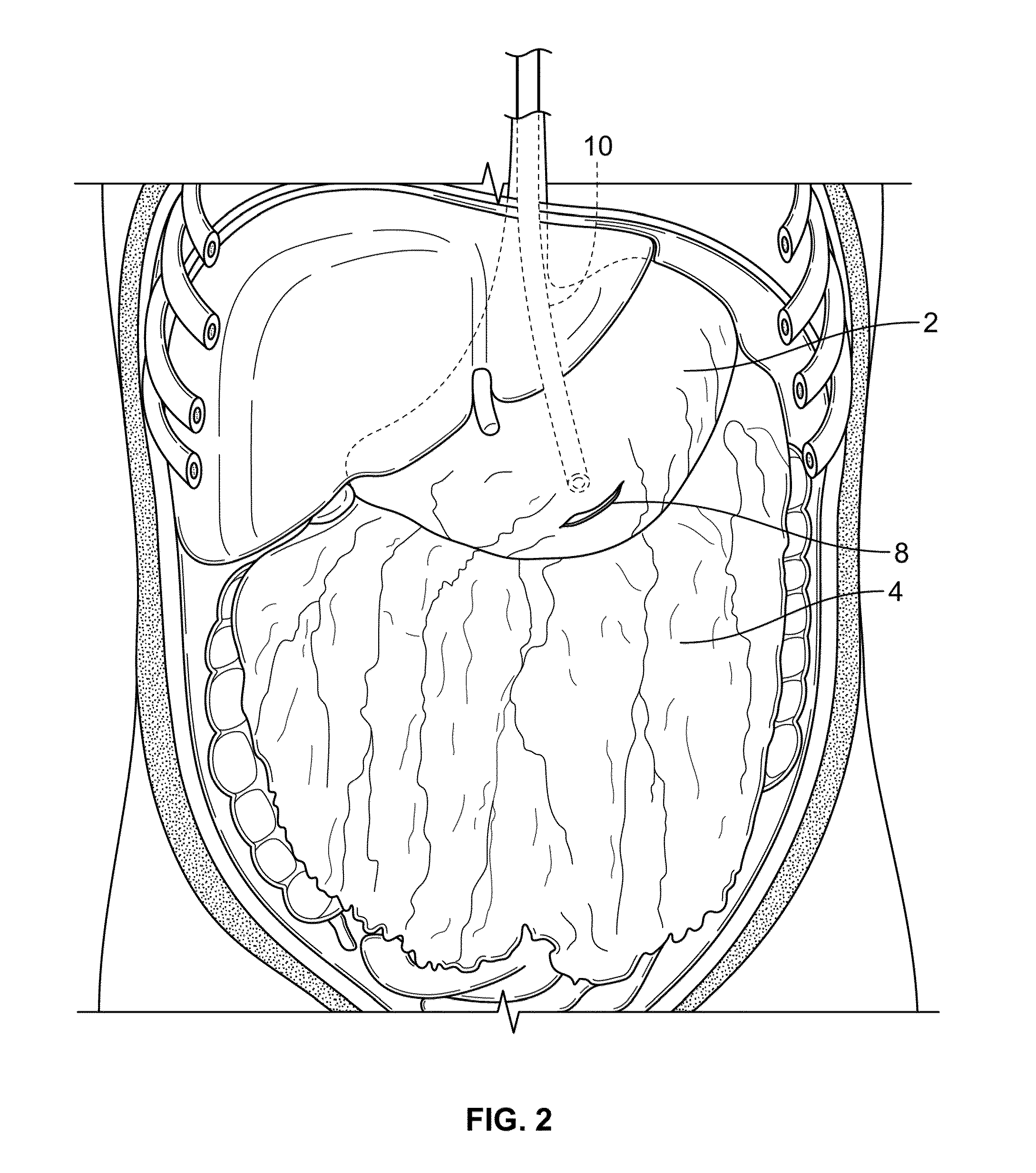 Methods and devices for removing omental tissue