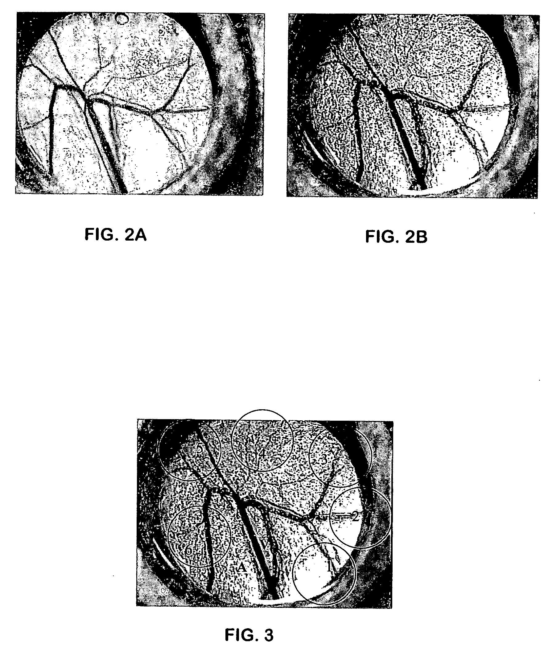 Laser treatment of cutaneous vascular lesions