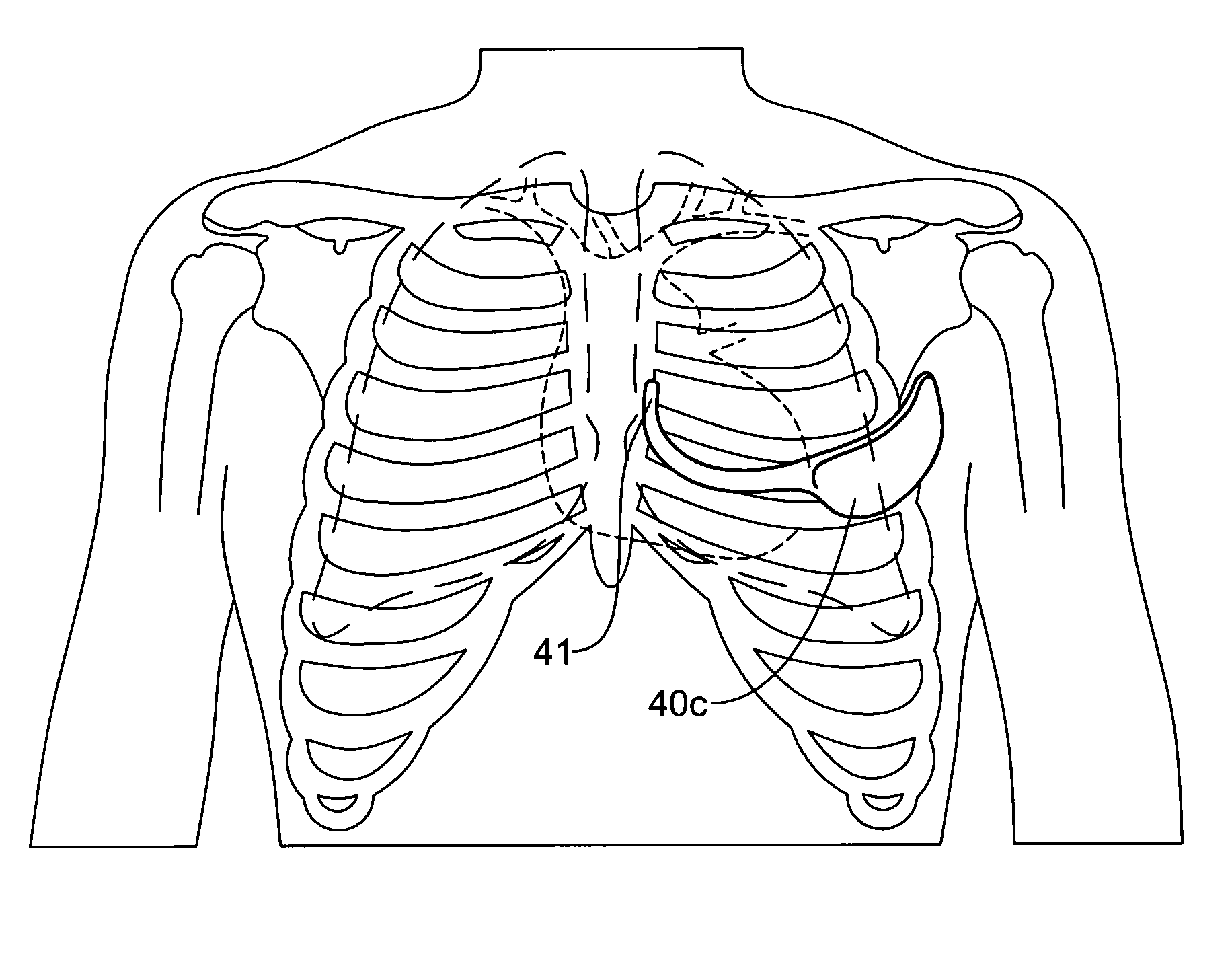 Subcutaneous cardiac stimulator with small contact surface electrodes