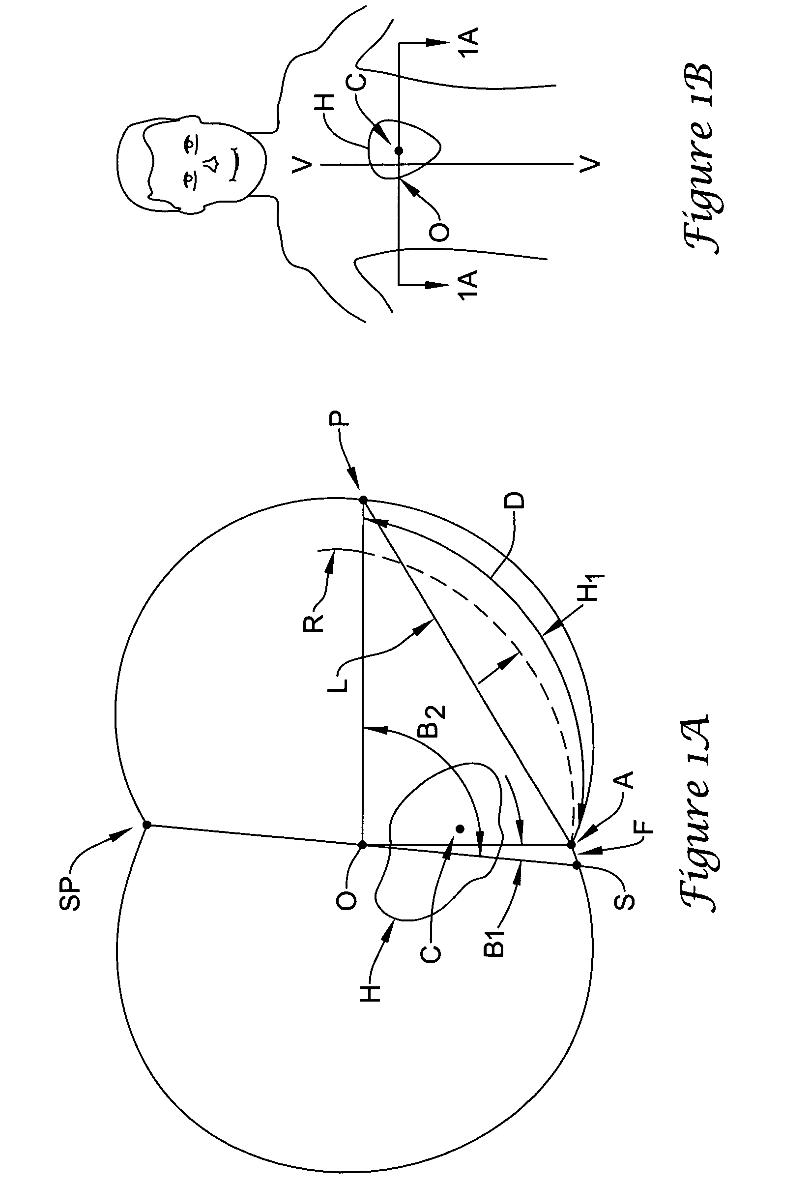 Subcutaneous cardiac stimulator with small contact surface electrodes