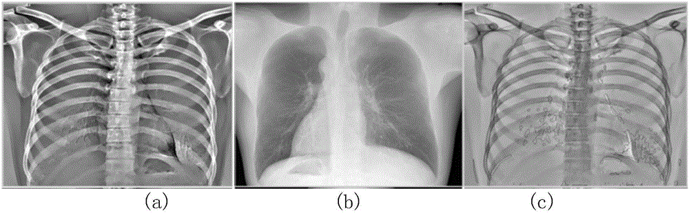 Method for detecting motion artifact area based on gradient correlation between bone image and soft tissue image in dual energy subtraction