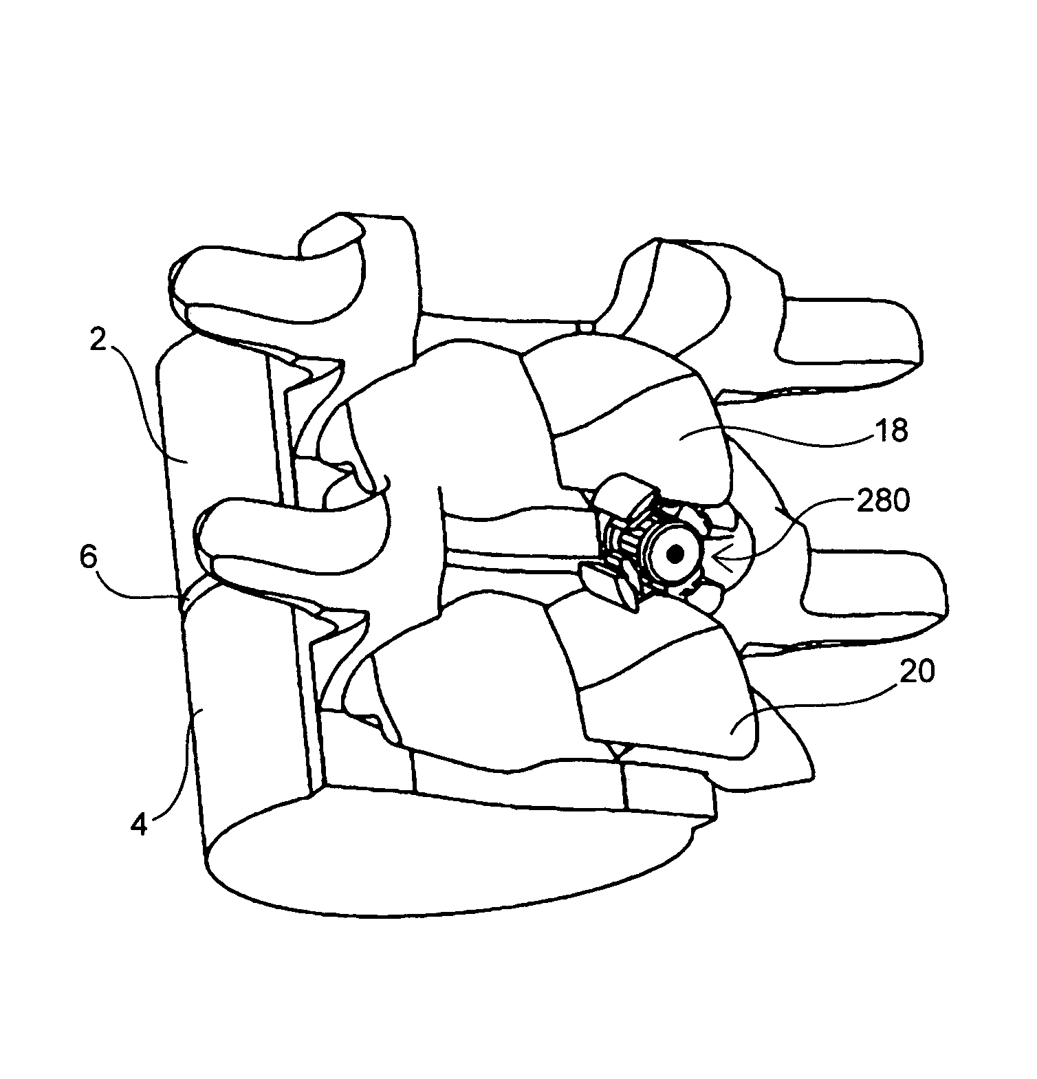 Systems and methods for posterior dynamic stabilization of the spine