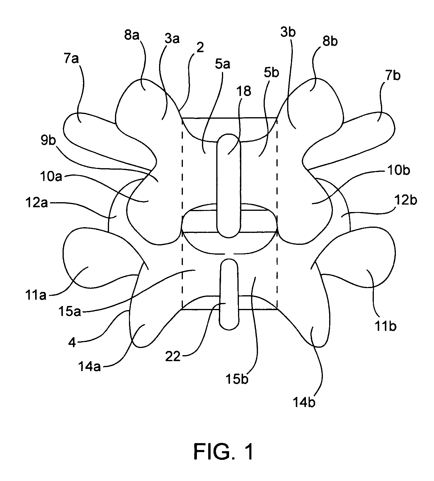 Systems and methods for posterior dynamic stabilization of the spine