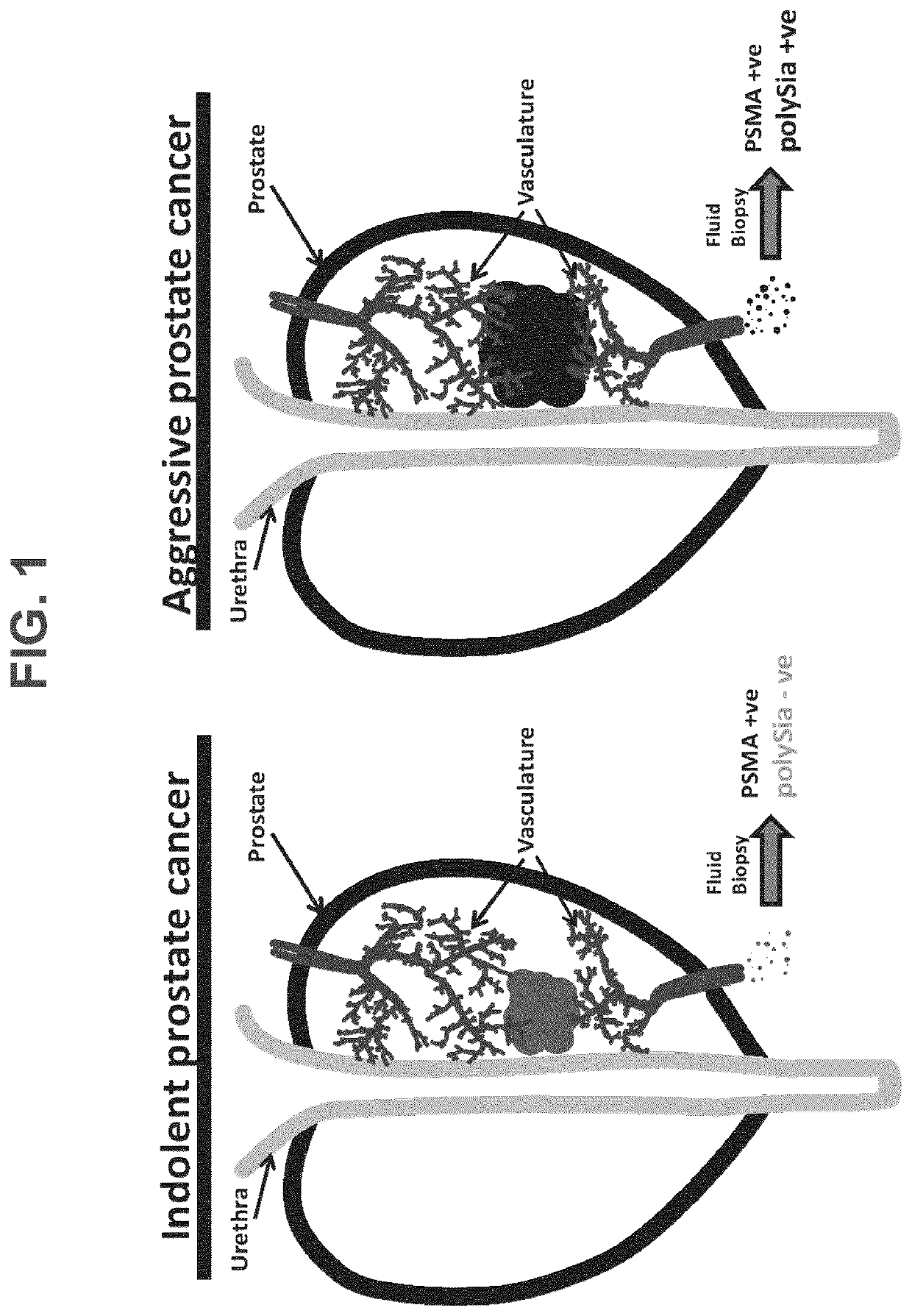 Methods for diagnosing high-risk cancer using polysialic acid and one or more tissue-specific biomarkers