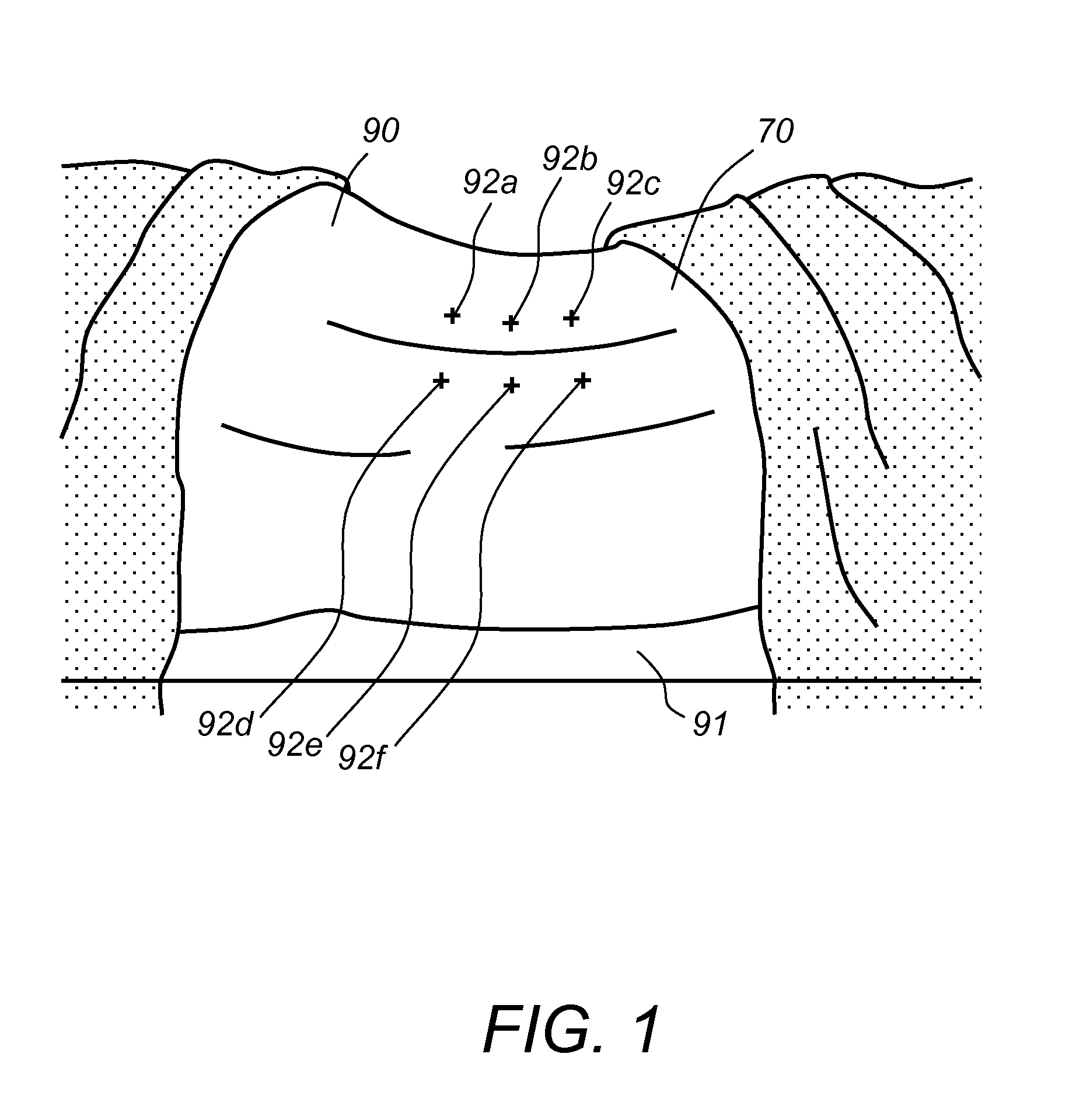 System and method for implanting spinal stabilization devices