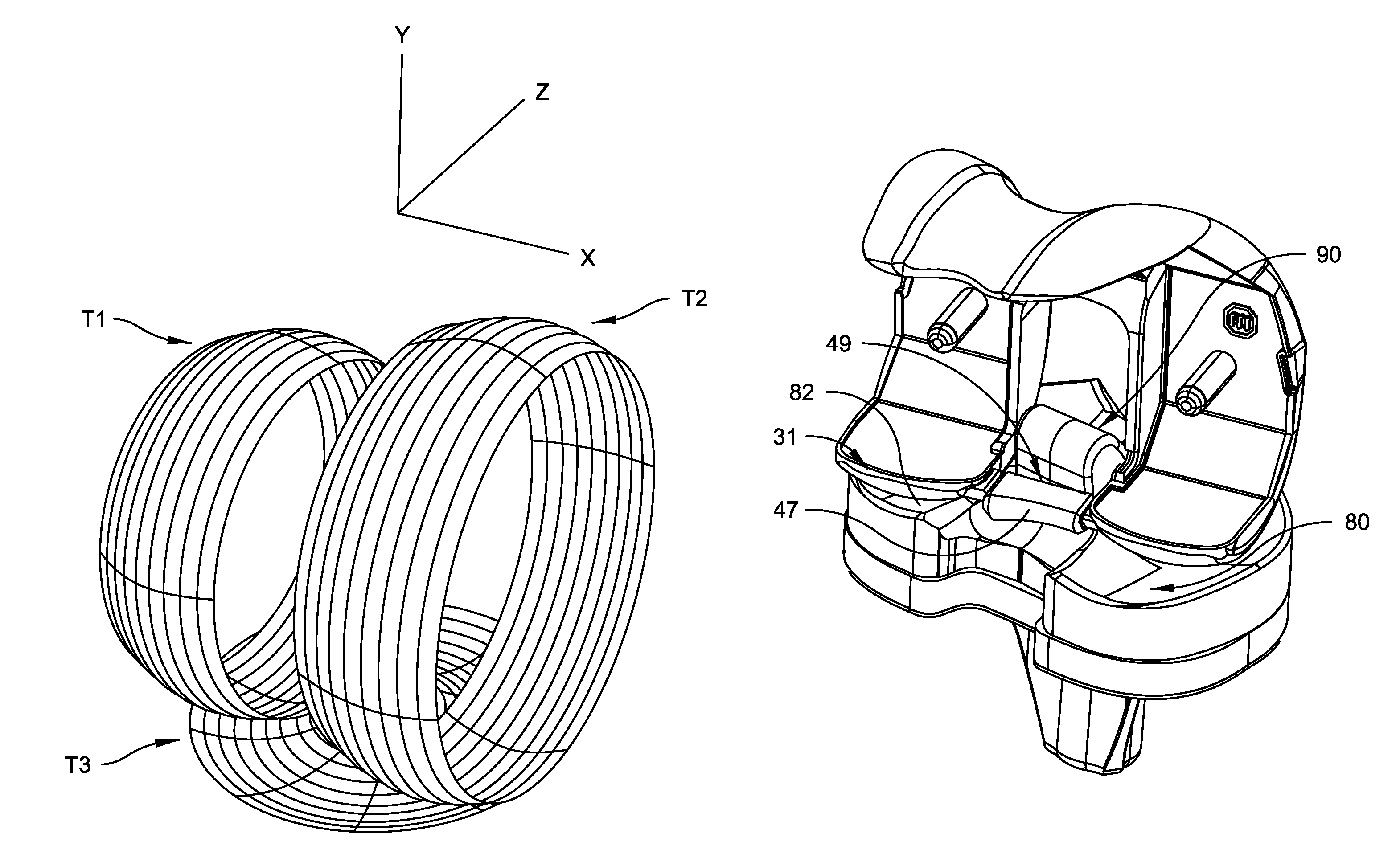 Total knee replacement prosthesis