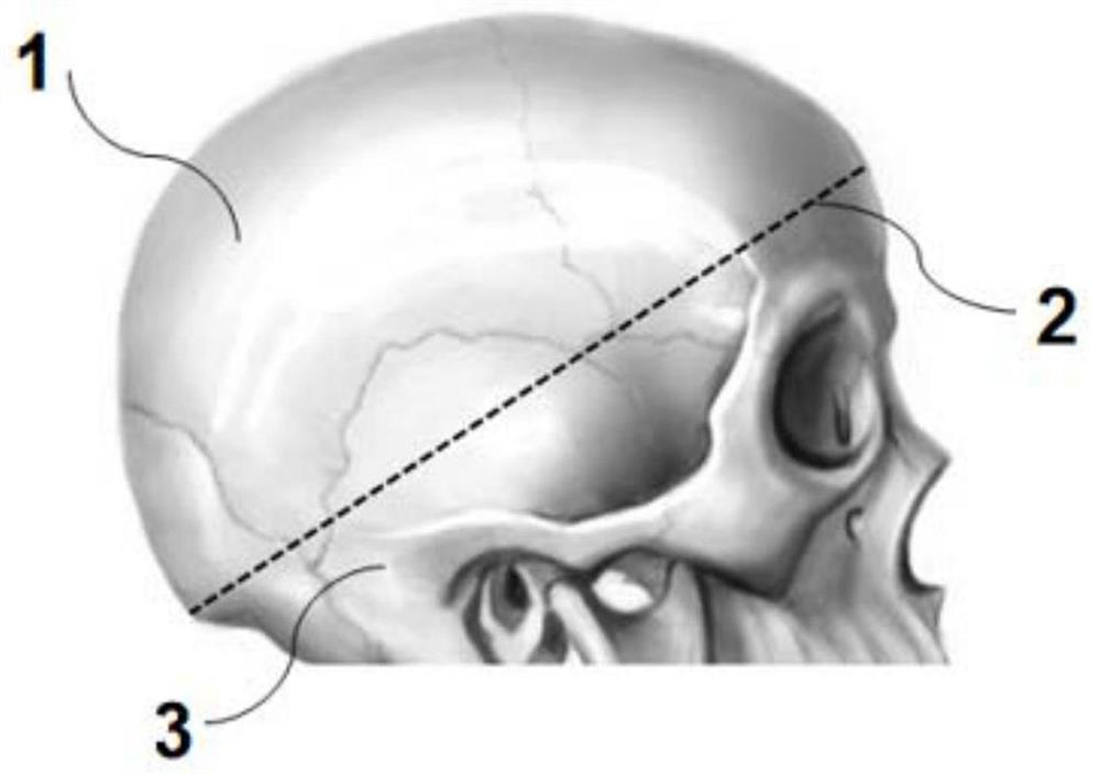 3D printing cerebral hemorrhage model for puncture training and efficient manufacturing method thereof