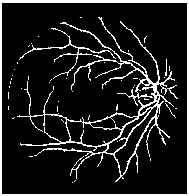 Automatic retinal blood vessel segmentation for clinical diagnosis of glaucoma