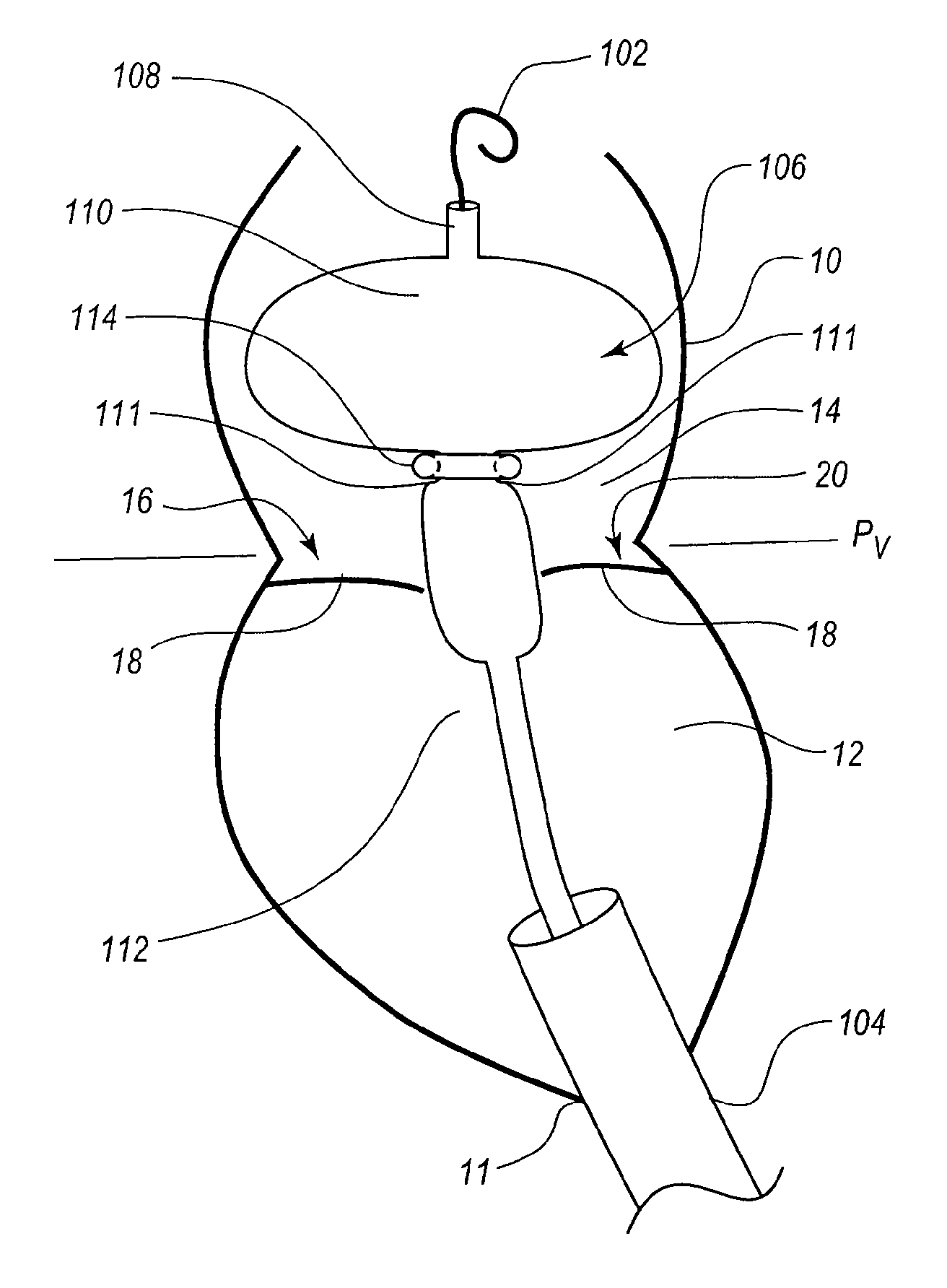 Percutaneous transcatheter repair of heart valves via trans-apical access