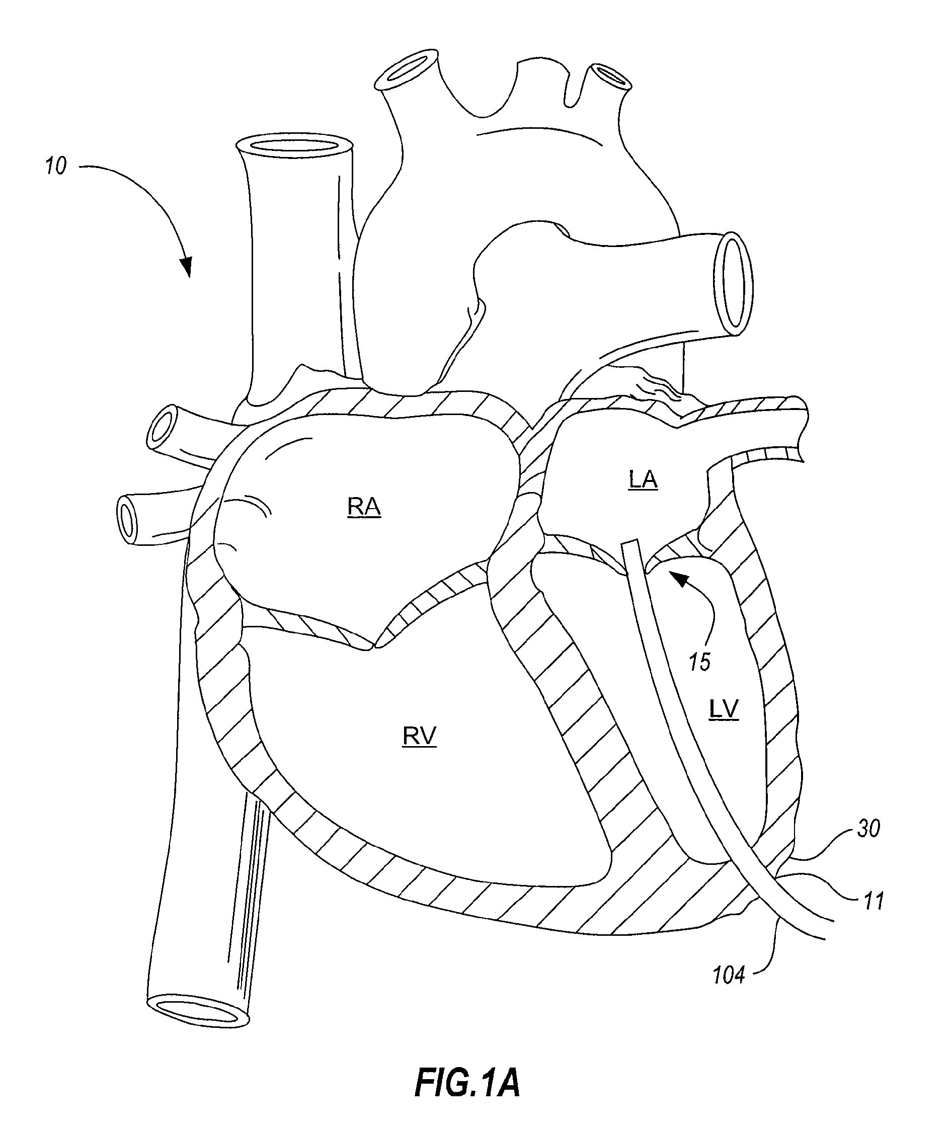 Percutaneous transcatheter repair of heart valves via trans-apical access