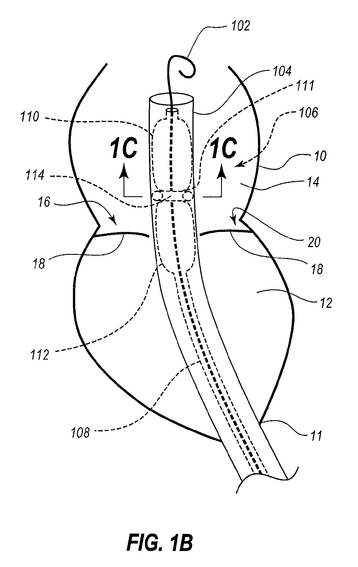 Percutaneous transcatheter repair of heart valves via trans-apical access