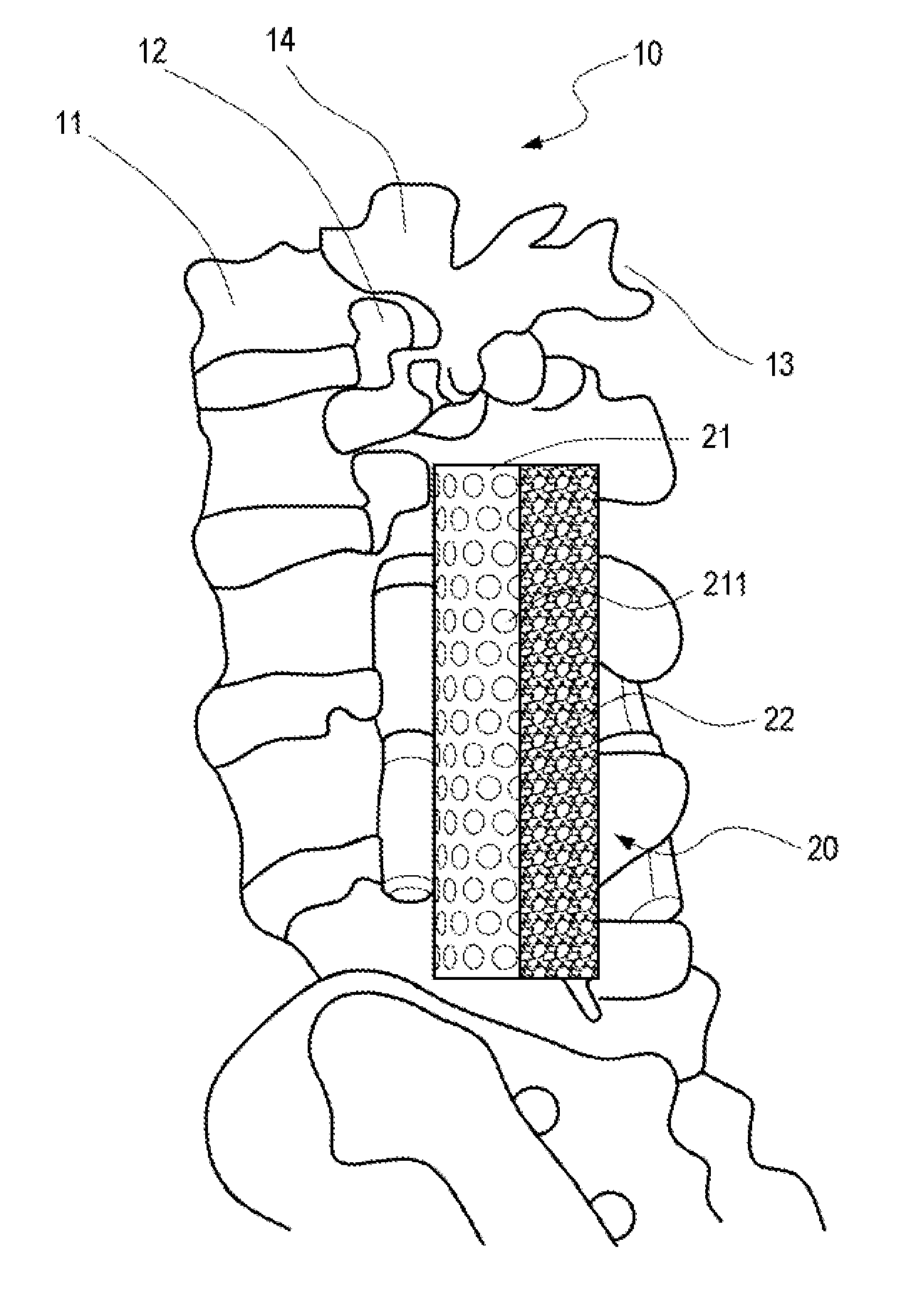 Spinal implant structure and method for manufacturing the same