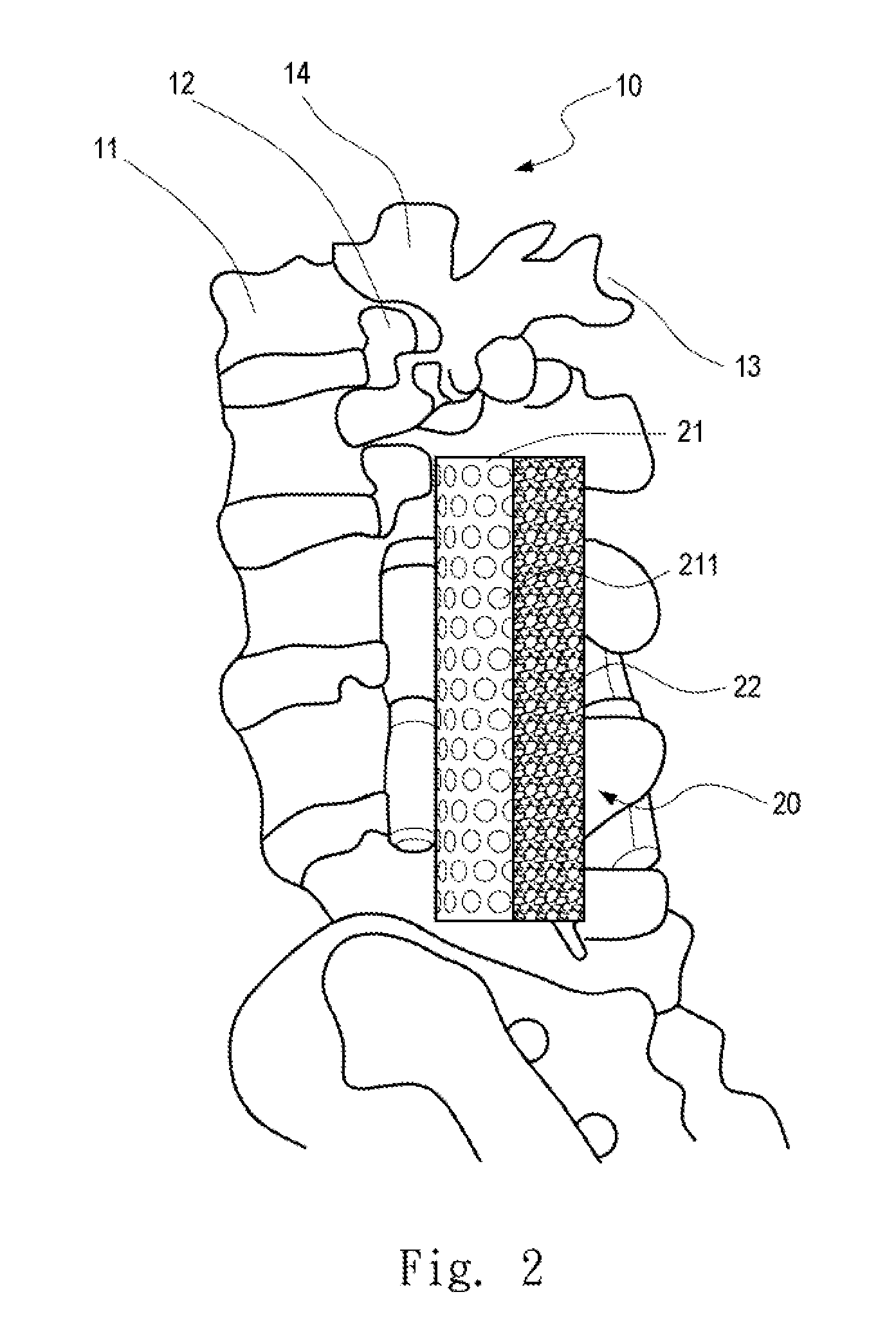 Spinal implant structure and method for manufacturing the same