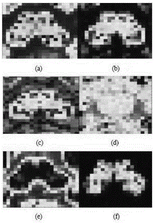 Comprehensive analytical method for predicting early-stage Parkinson's disease