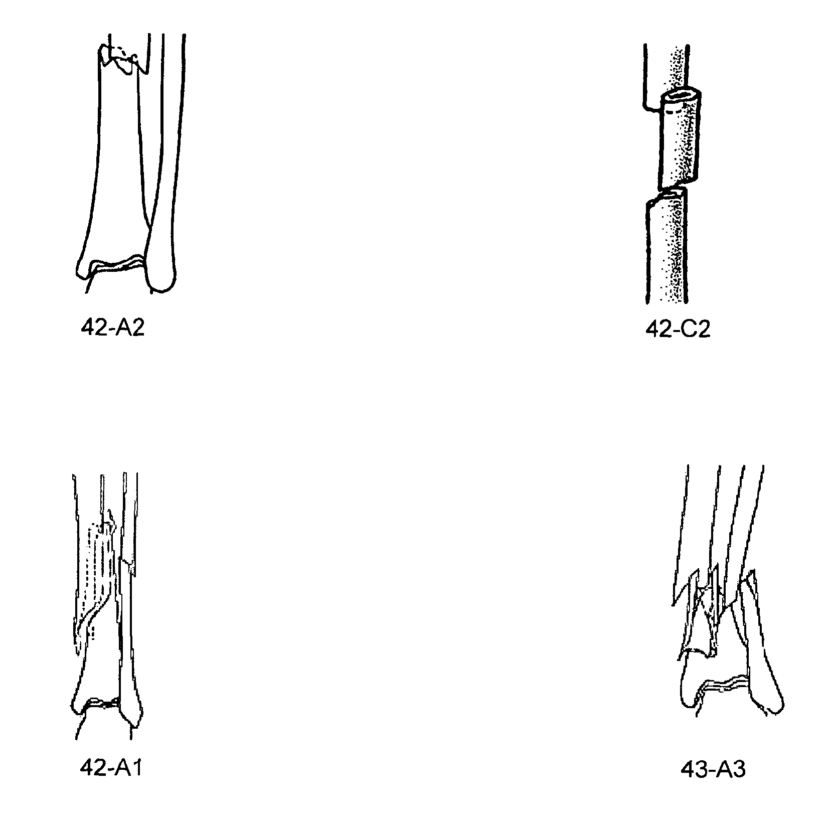 Telemetric orthopaedic implant