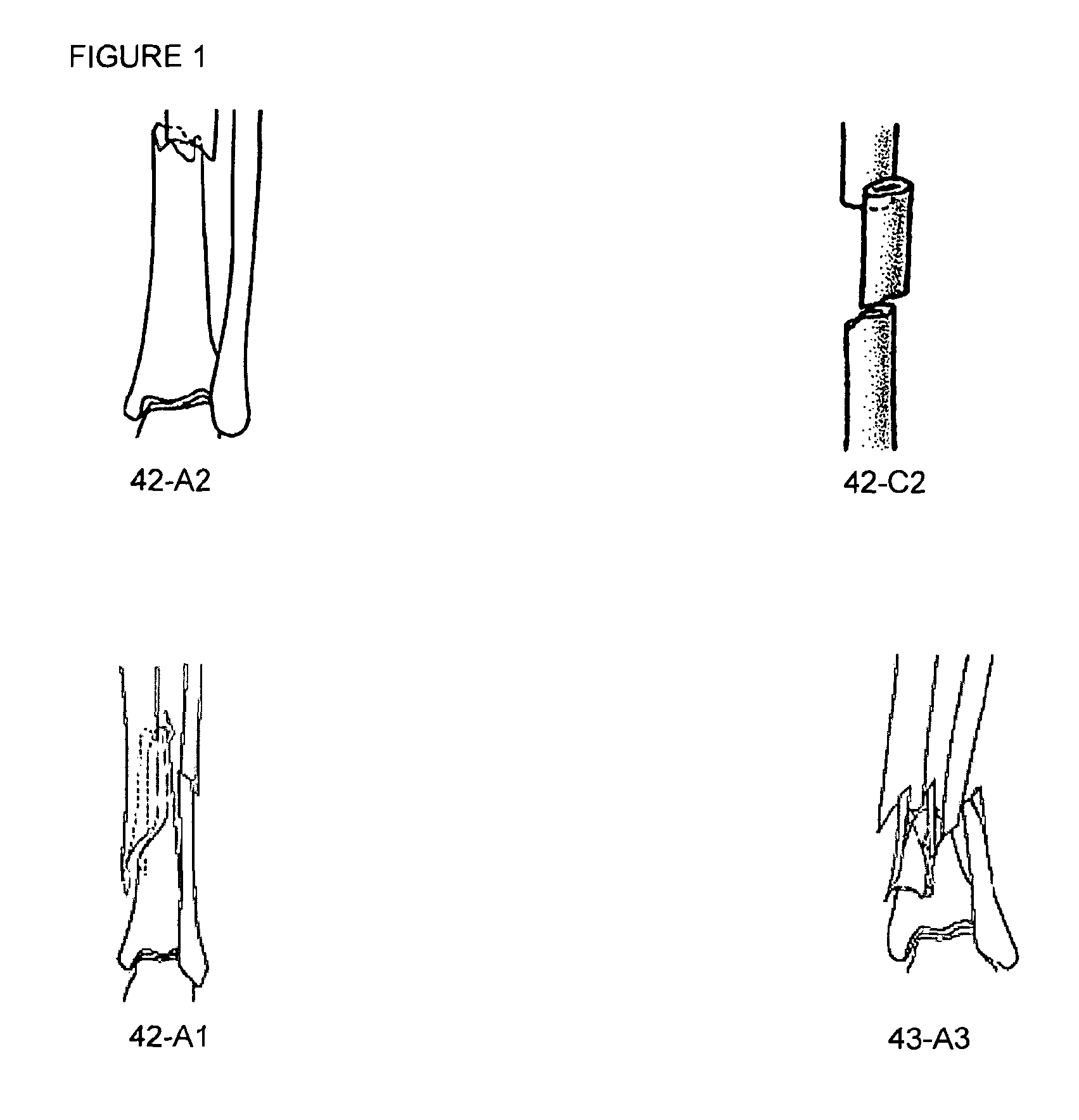 Telemetric orthopaedic implant