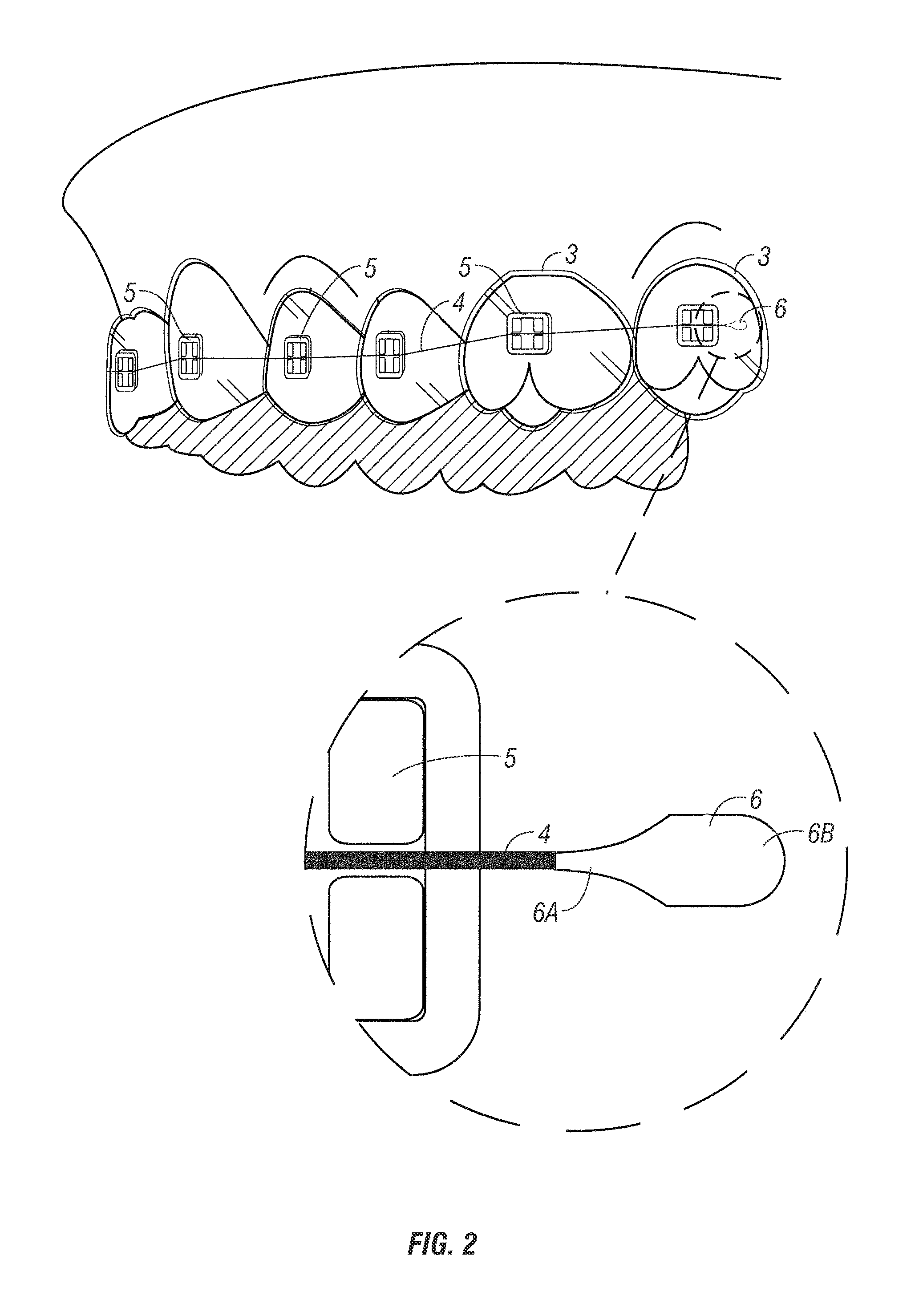 Orthodontic appliance system