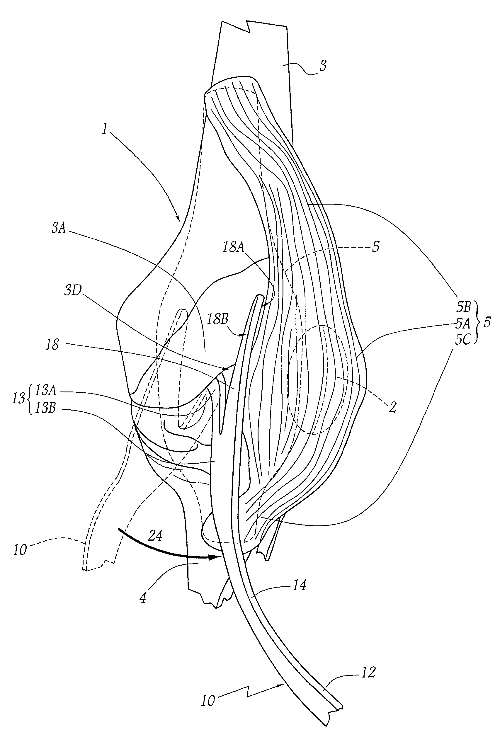 Patellar retractor and method of surgical procedure on knee