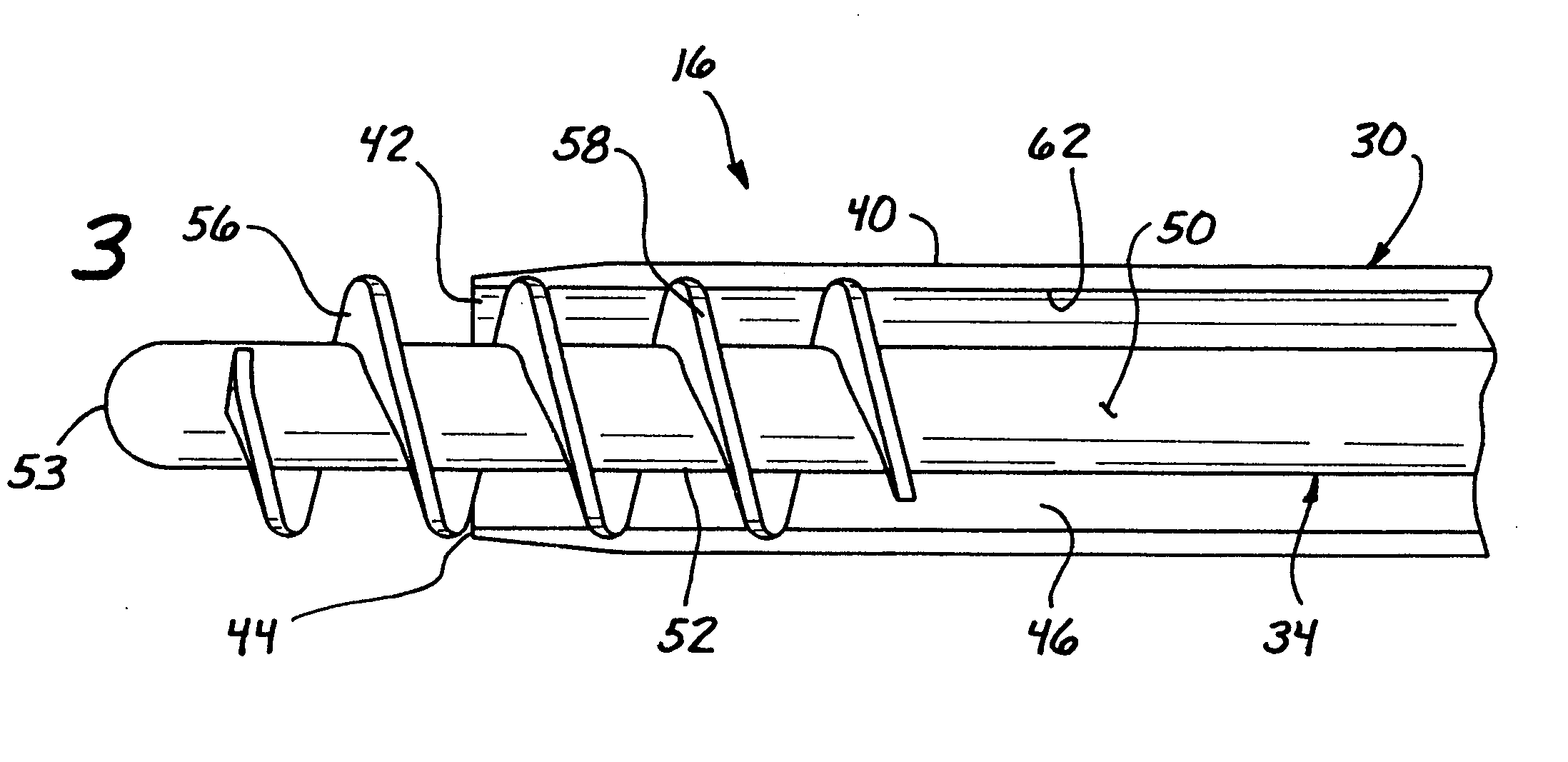 Micro-invasive tissue removal device