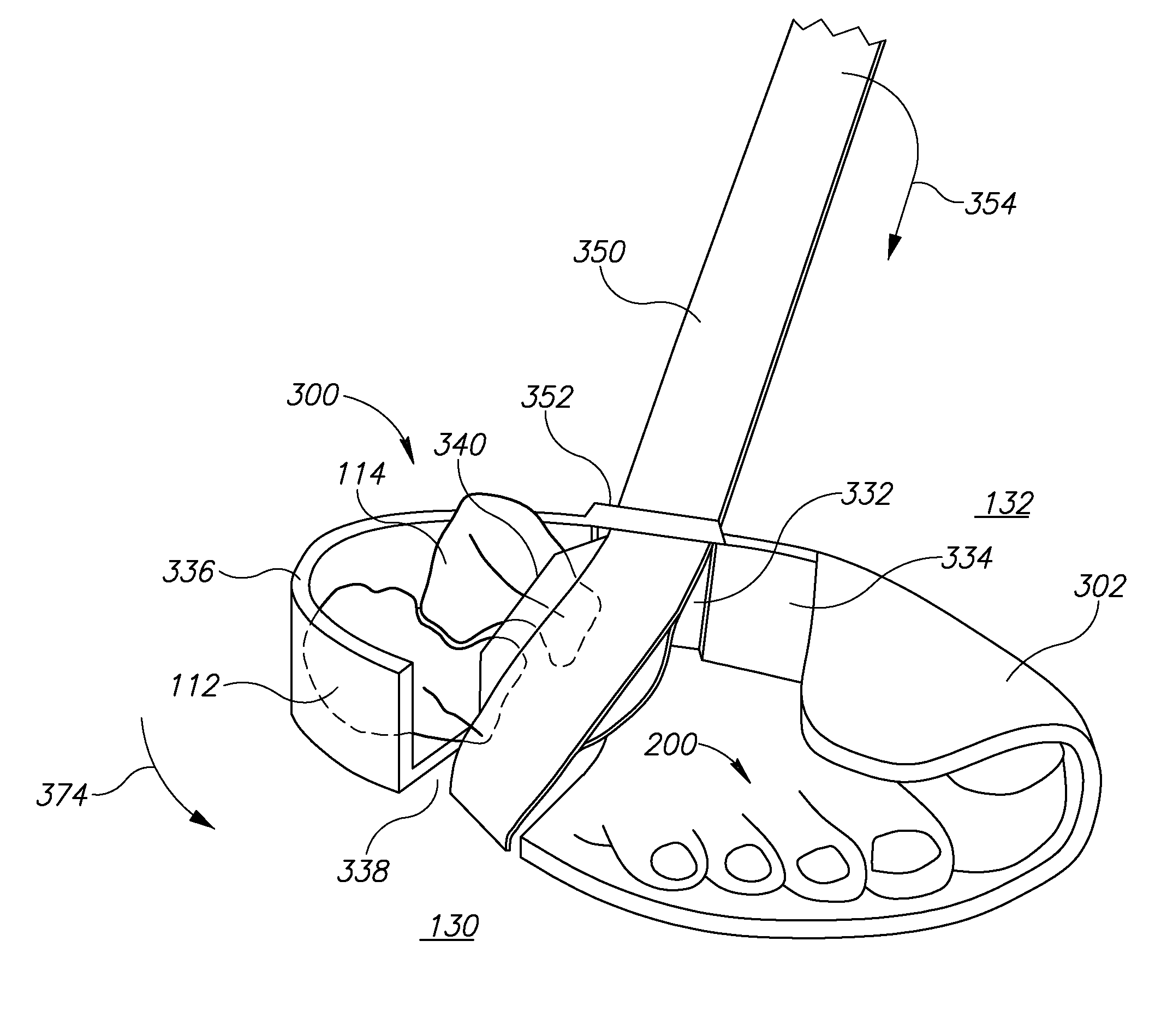 Clubfoot orthotics