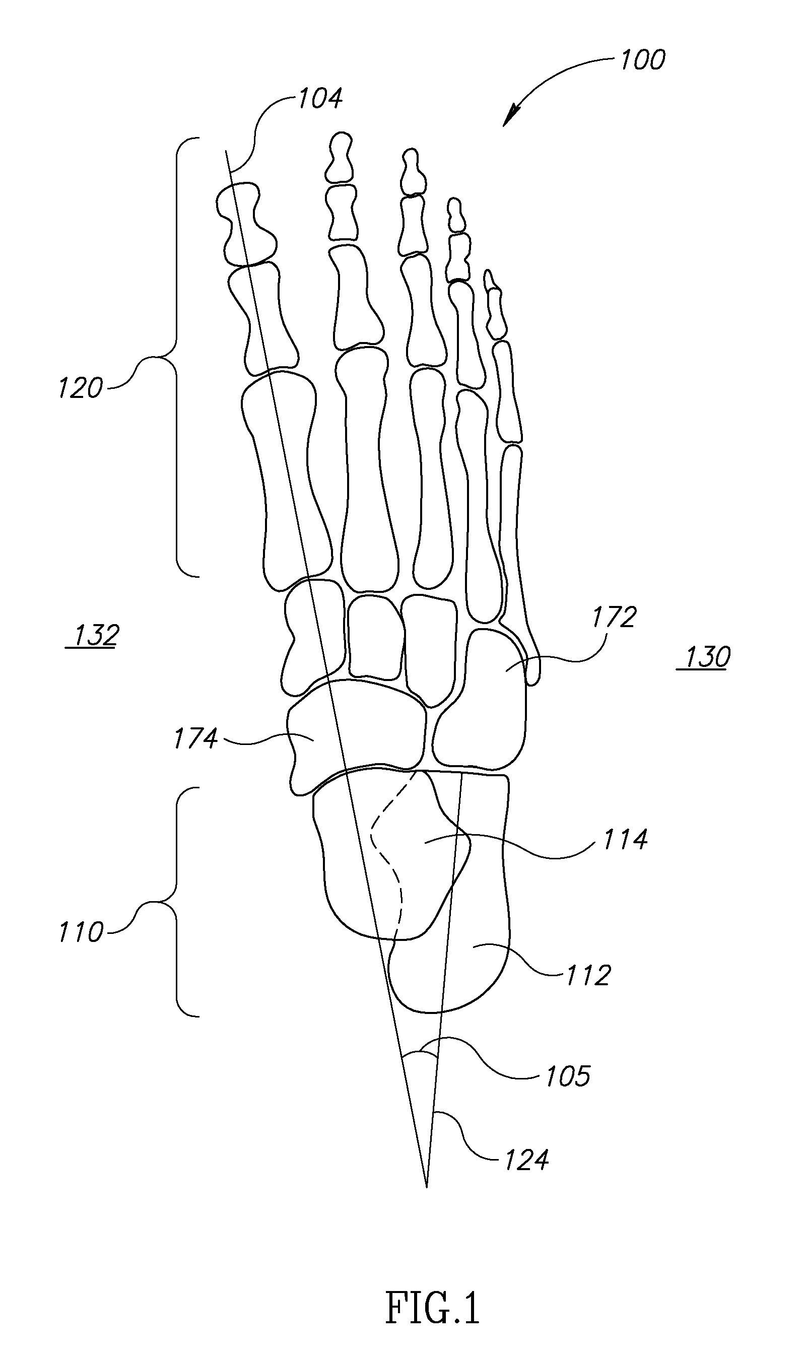 Clubfoot orthotics