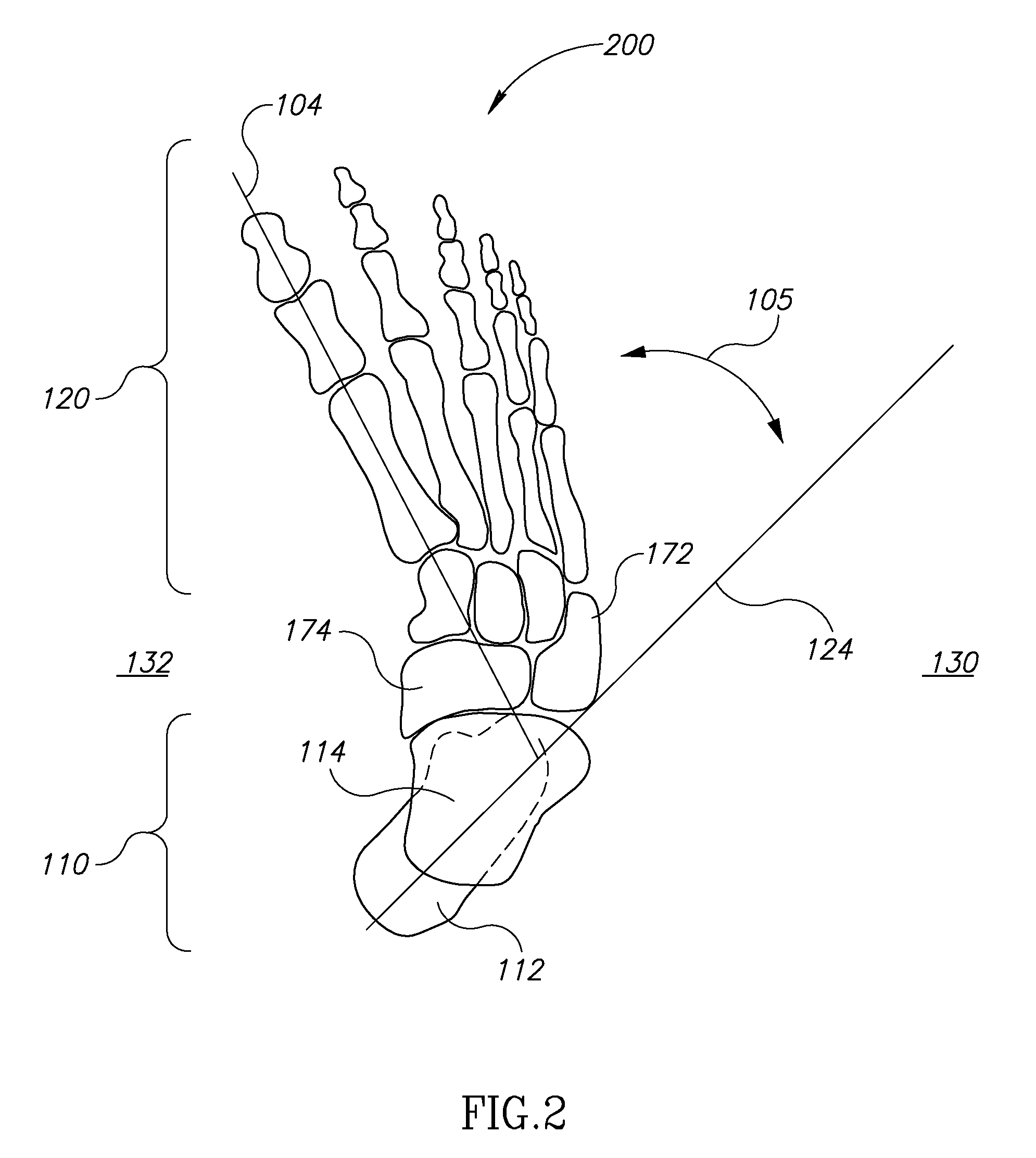 Clubfoot orthotics