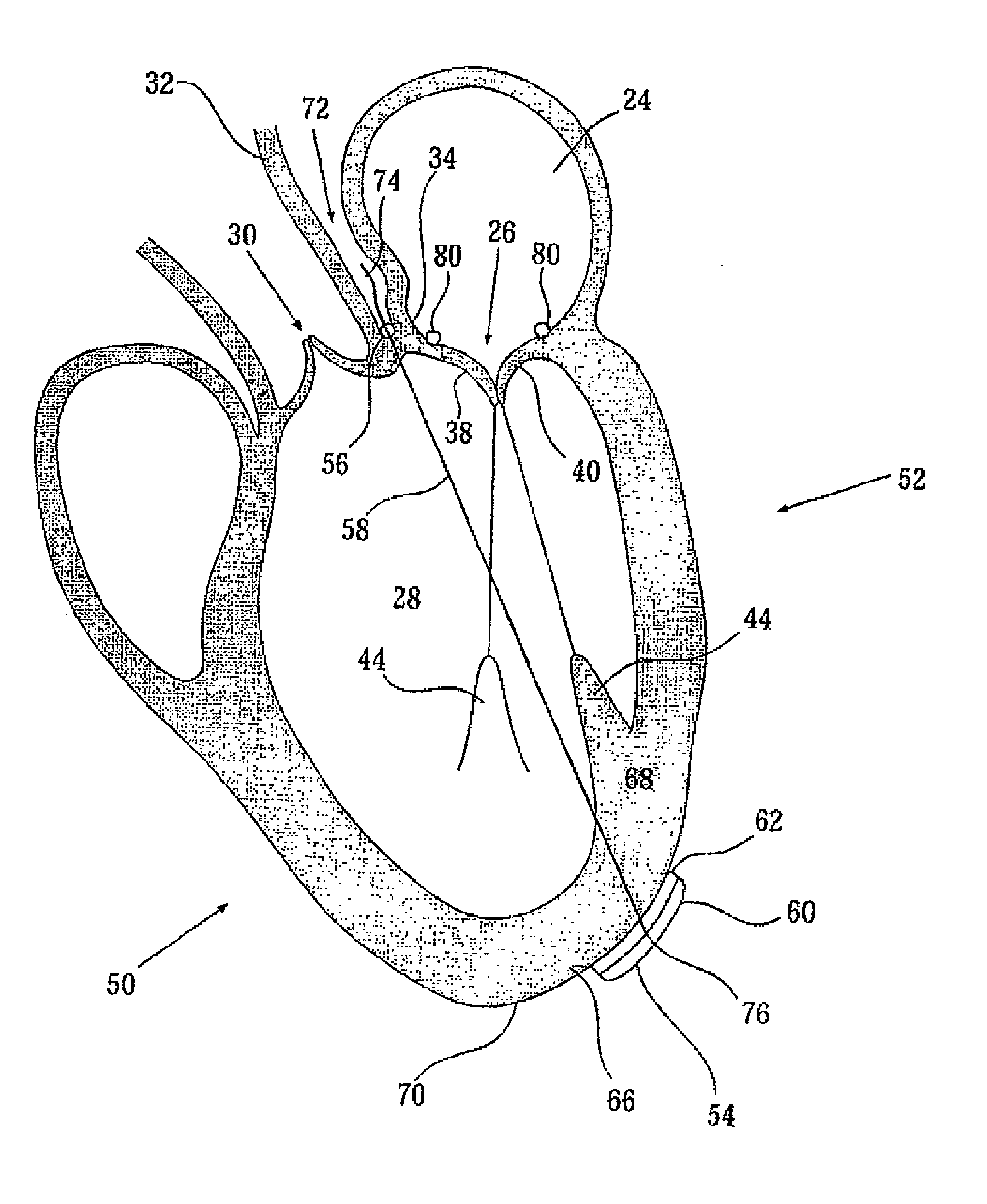 Elongated body for deployment in a coronary sinus