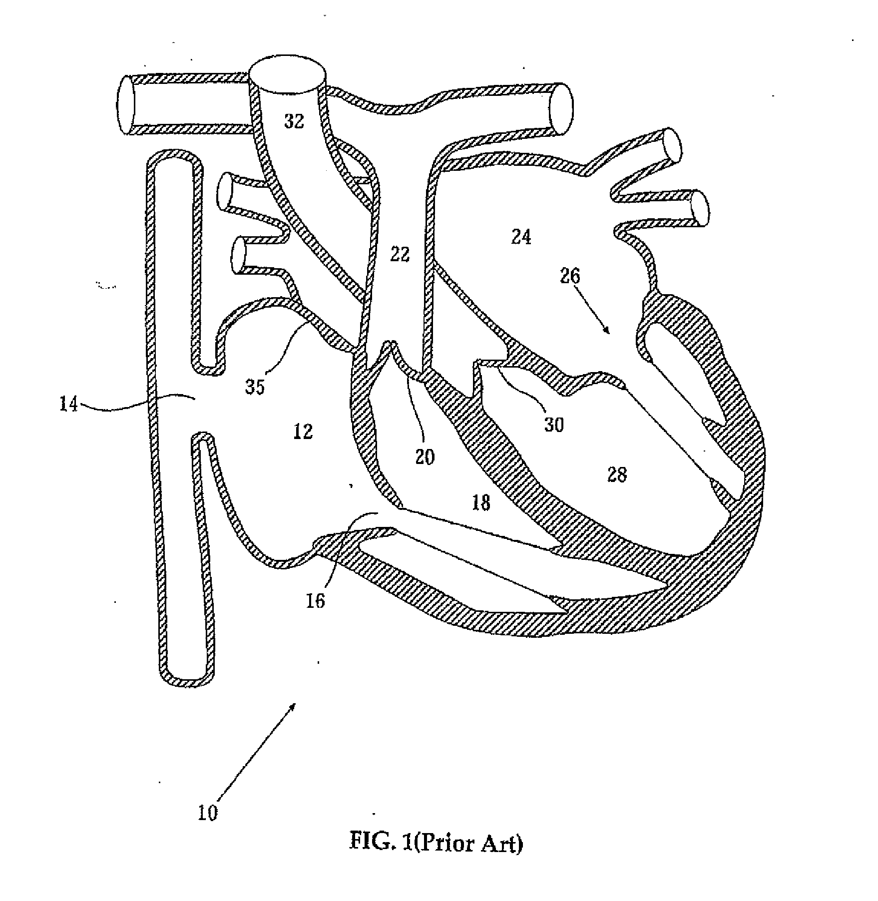 Elongated body for deployment in a coronary sinus