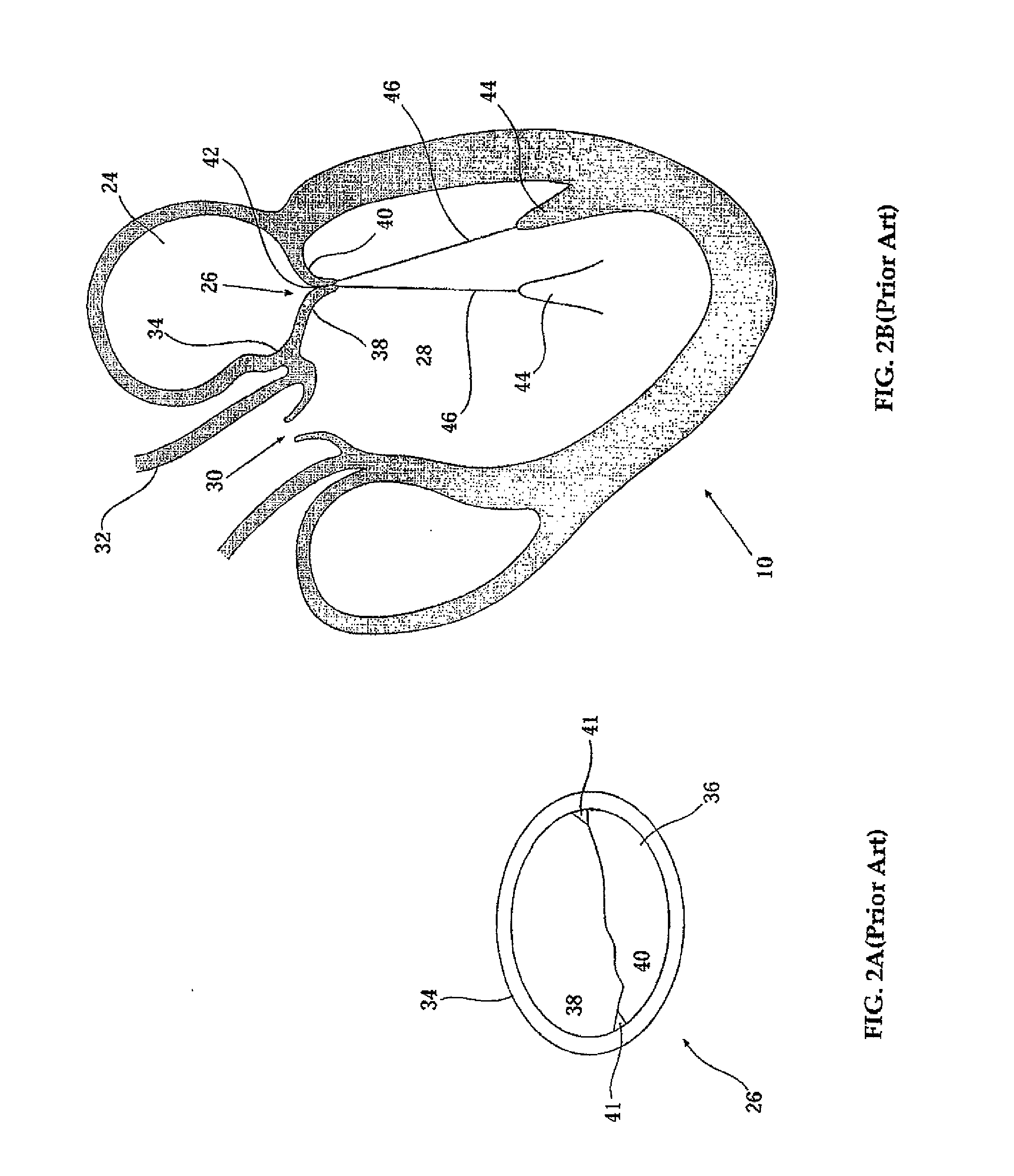 Elongated body for deployment in a coronary sinus