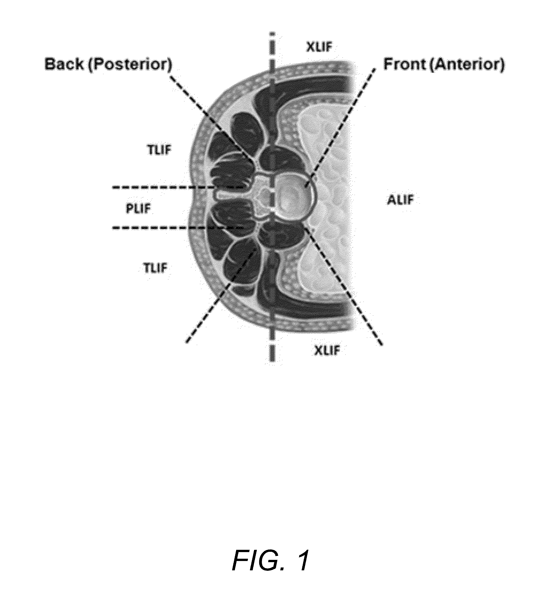 IBD Expandable Ti