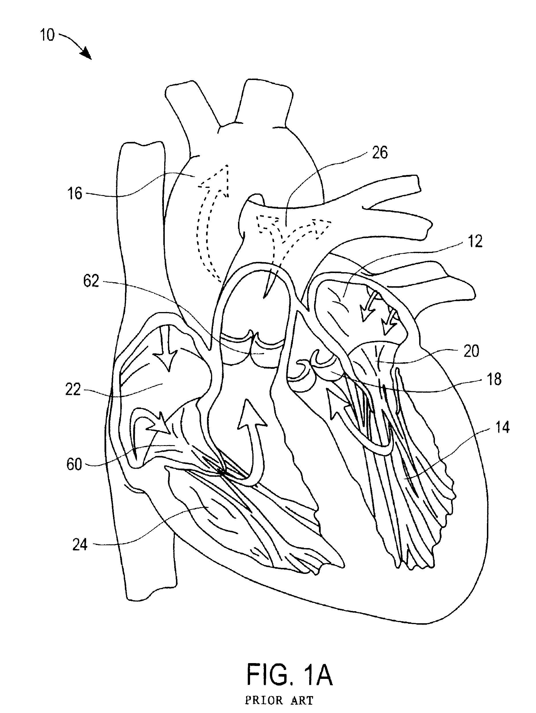 Apparatuses and methods for heart valve repair