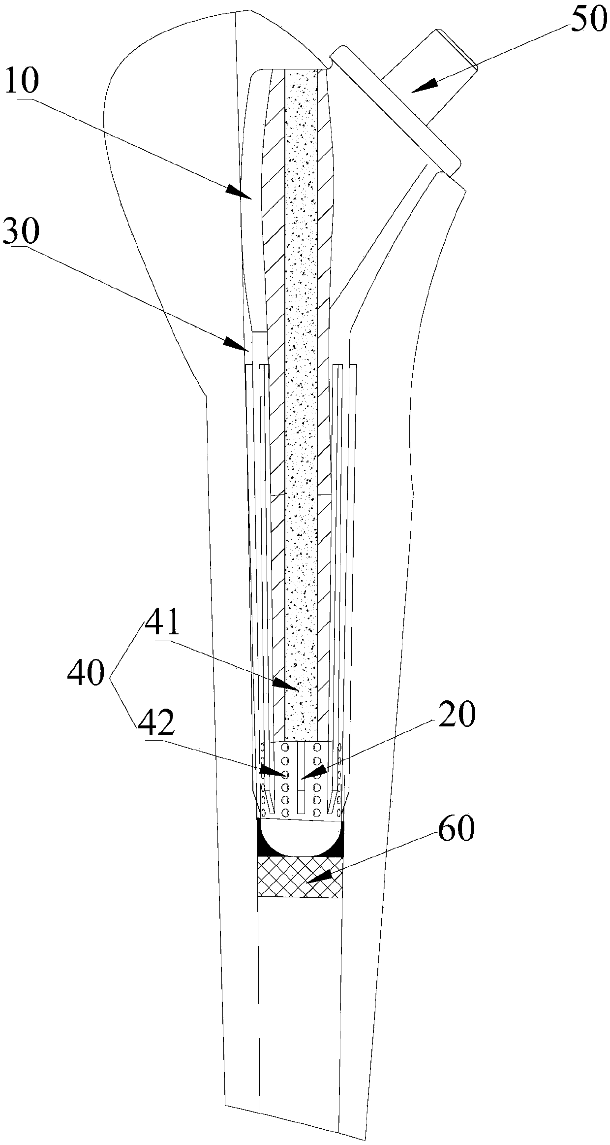 Shoulder-joint humerus handle prosthesis