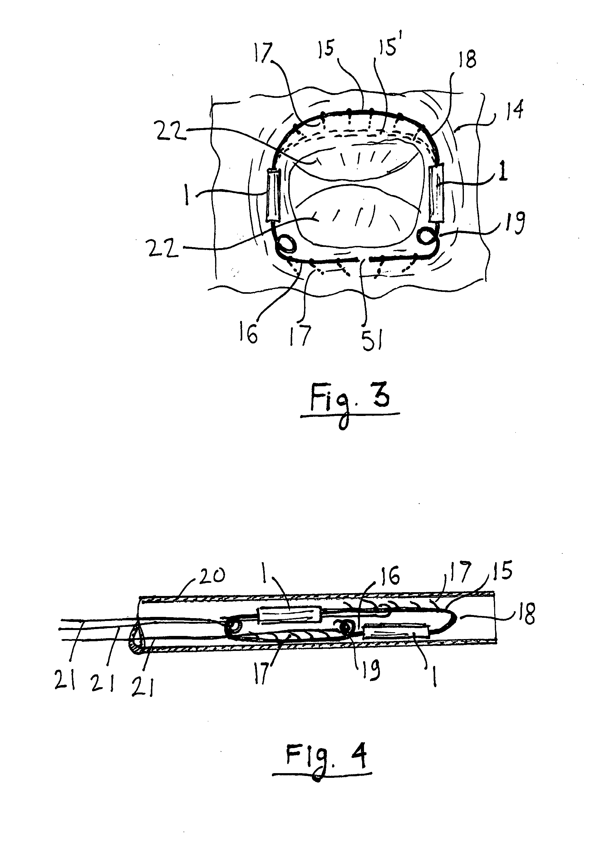 System for mechanical adjustment of medical implants