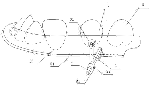 Method and device for implanting and locating micro planting nail for orthodontics