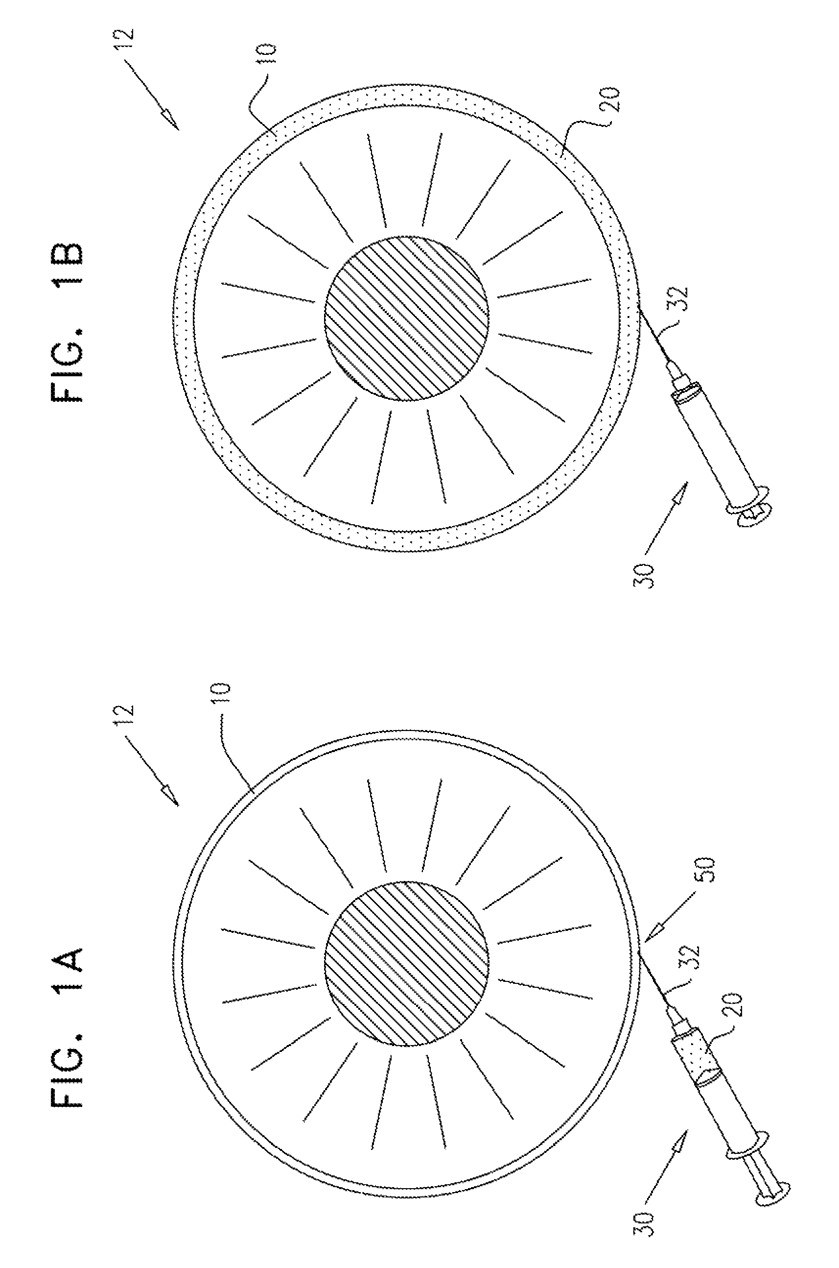 Injectable hydrogel implant for treating glaucoma