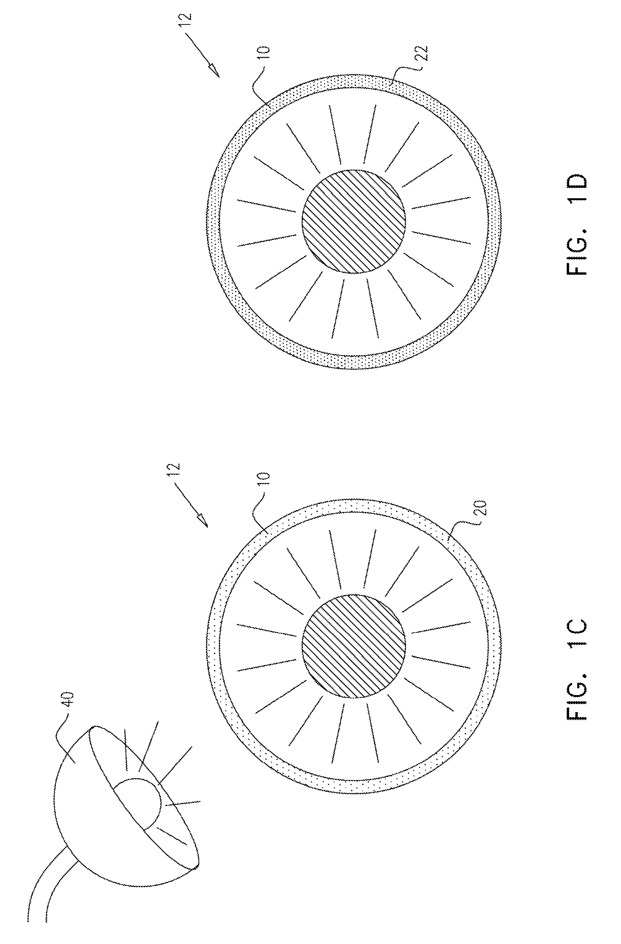 Injectable hydrogel implant for treating glaucoma