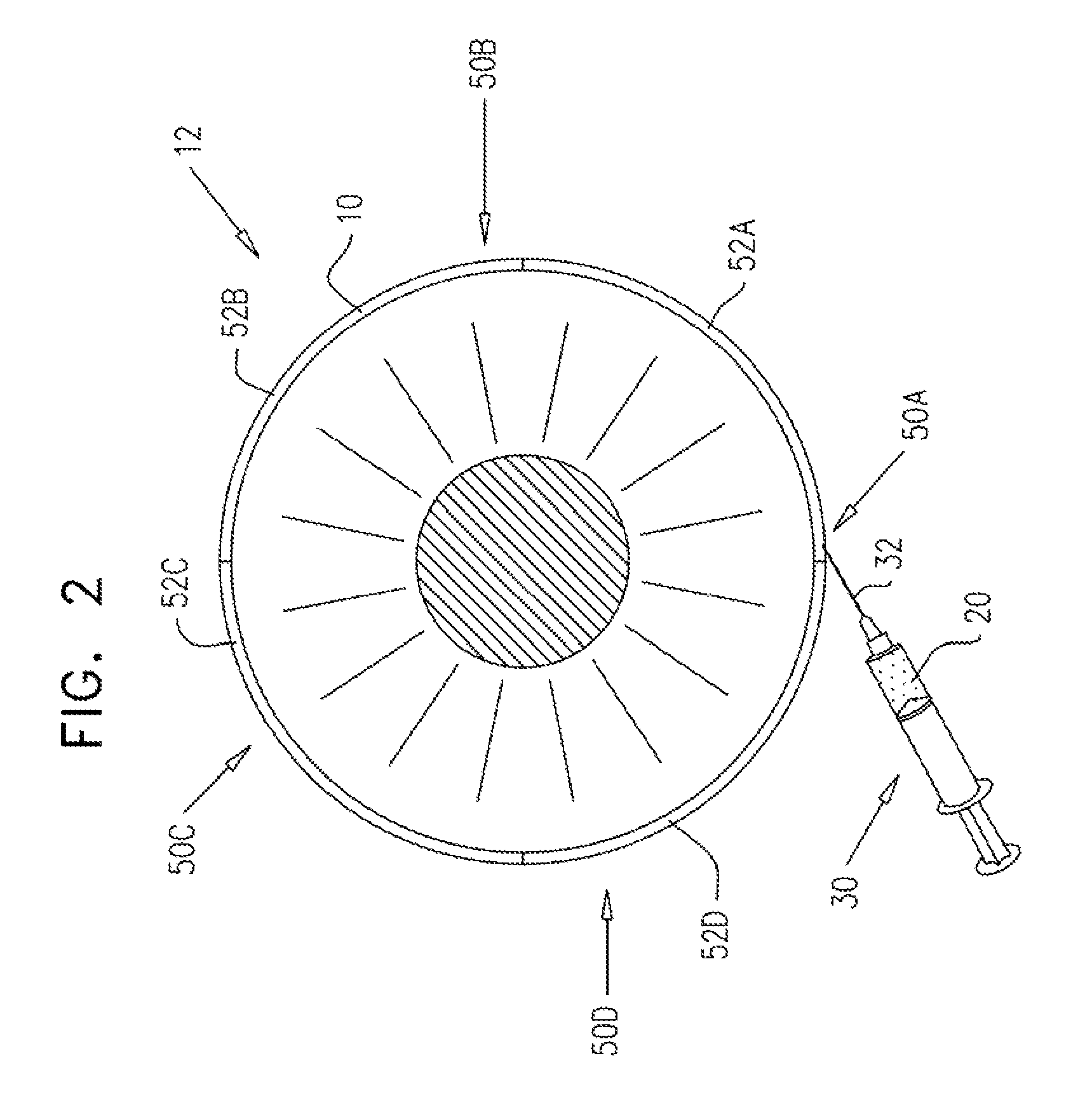 Injectable hydrogel implant for treating glaucoma