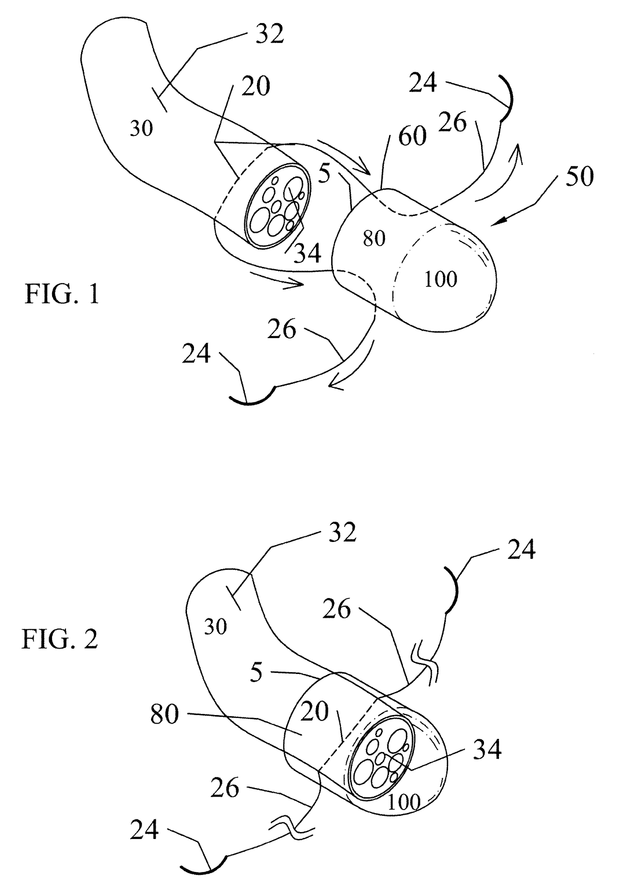 Implant devices with a pre-set pulley system