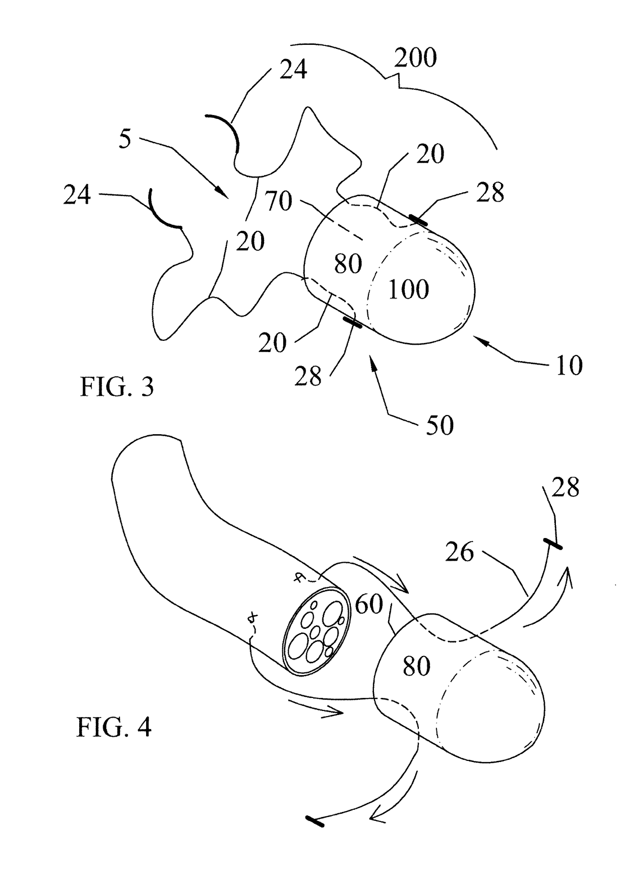 Implant devices with a pre-set pulley system